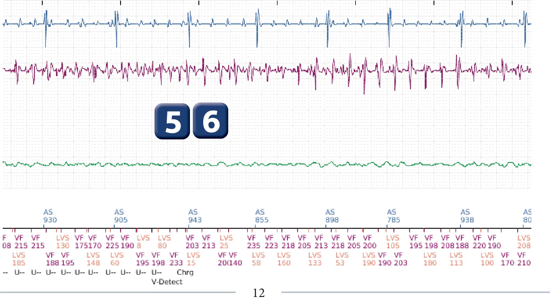 Boston Scientific ICD electrogram, segment 3 of 6 — Detection and treatment of a VF episode