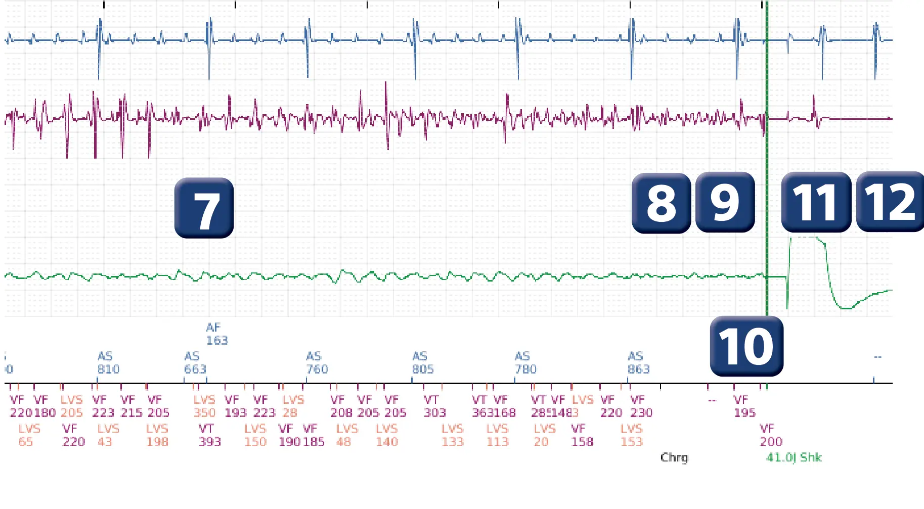 Boston Scientific ICD electrogram, segment 4 of 6 — Detection and treatment of a VF episode
