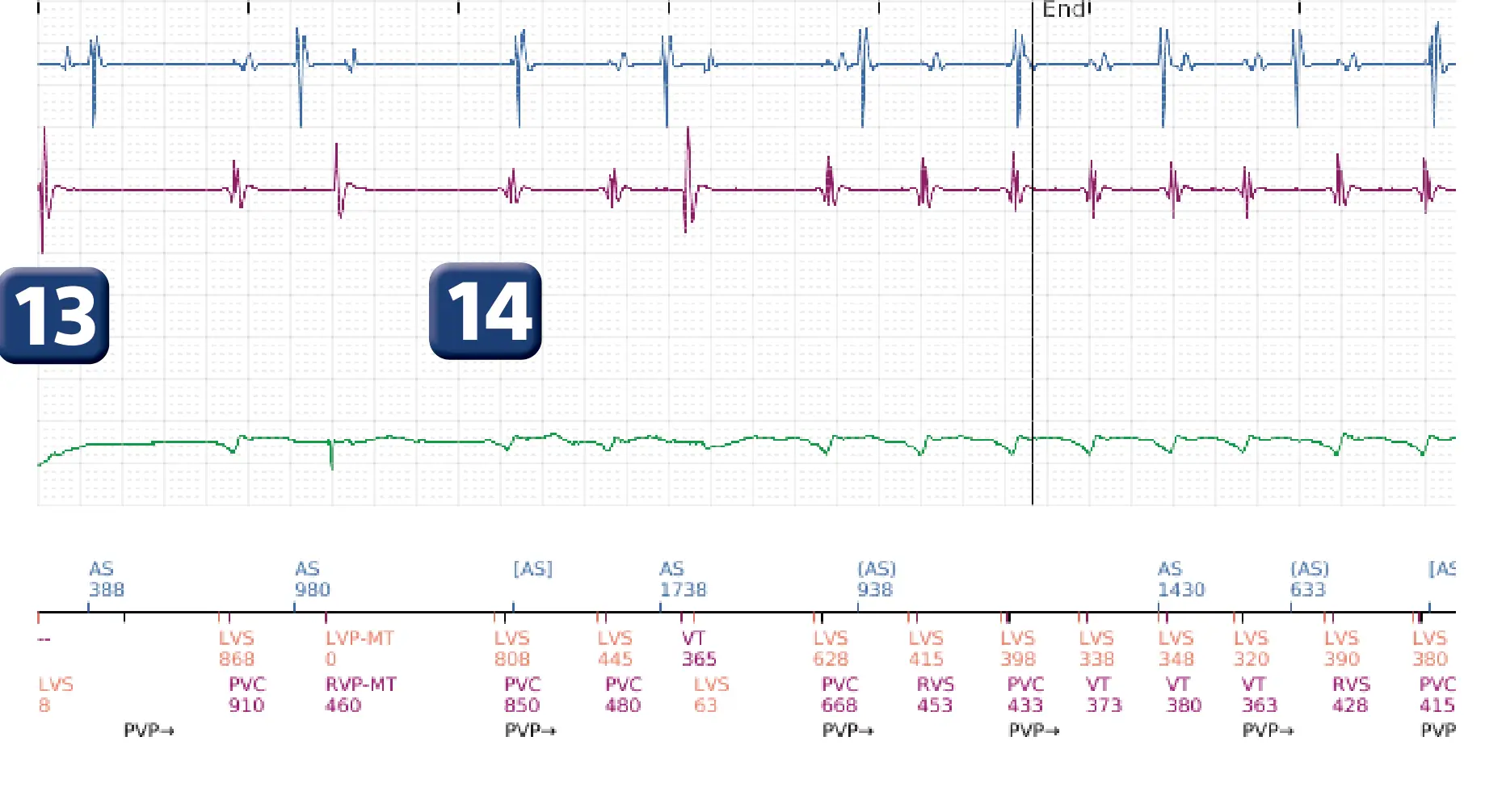 Boston Scientific ICD electrogram, segment 5 of 6 — Detection and treatment of a VF episode