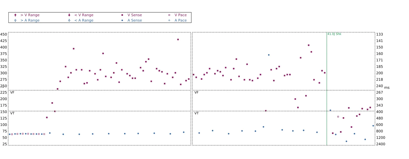 Interval plot — Detection and treatment of a VF episode