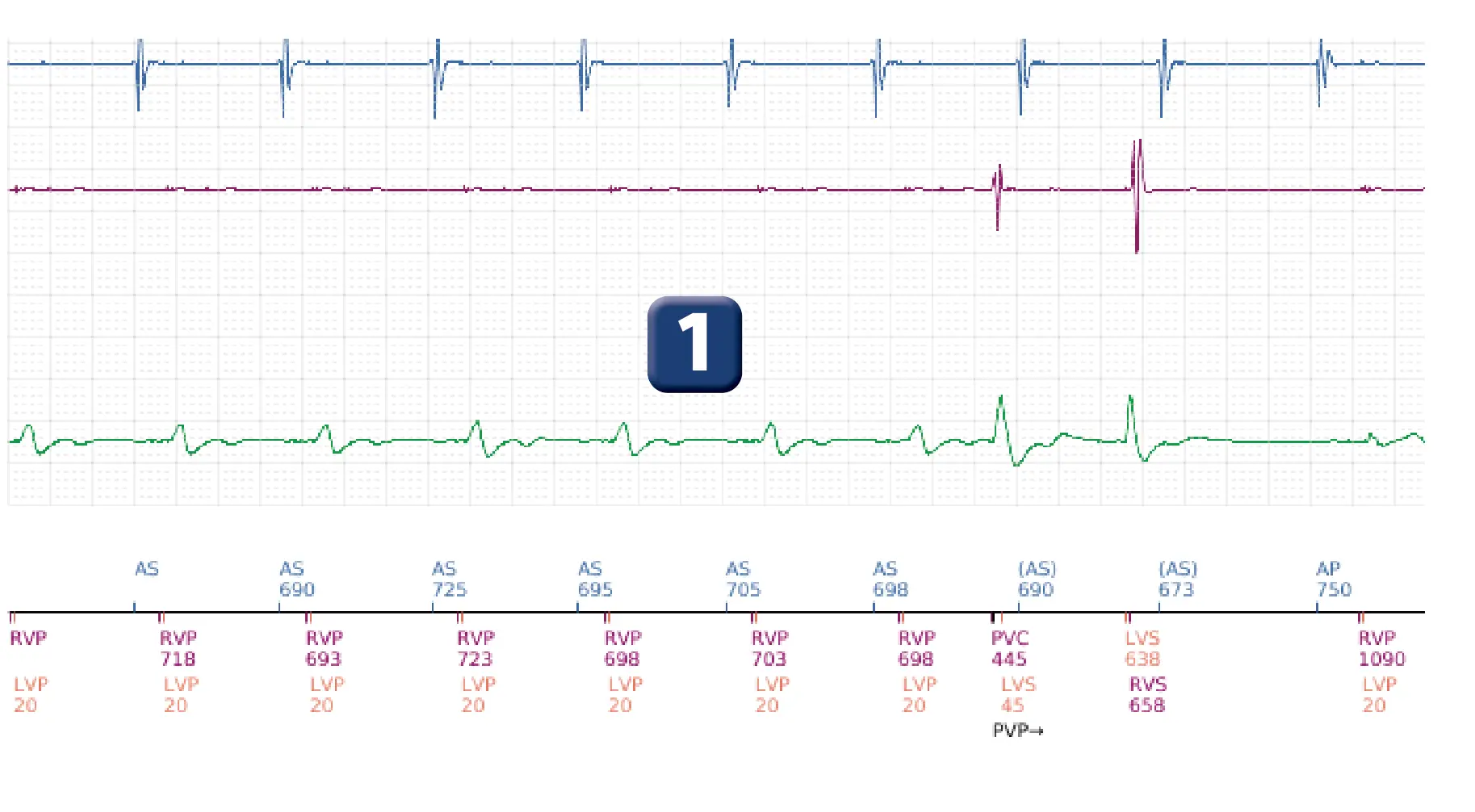 Boston Scientific ICD electrogram, segment 1 of 5 — Detection and treatment of a VT episode