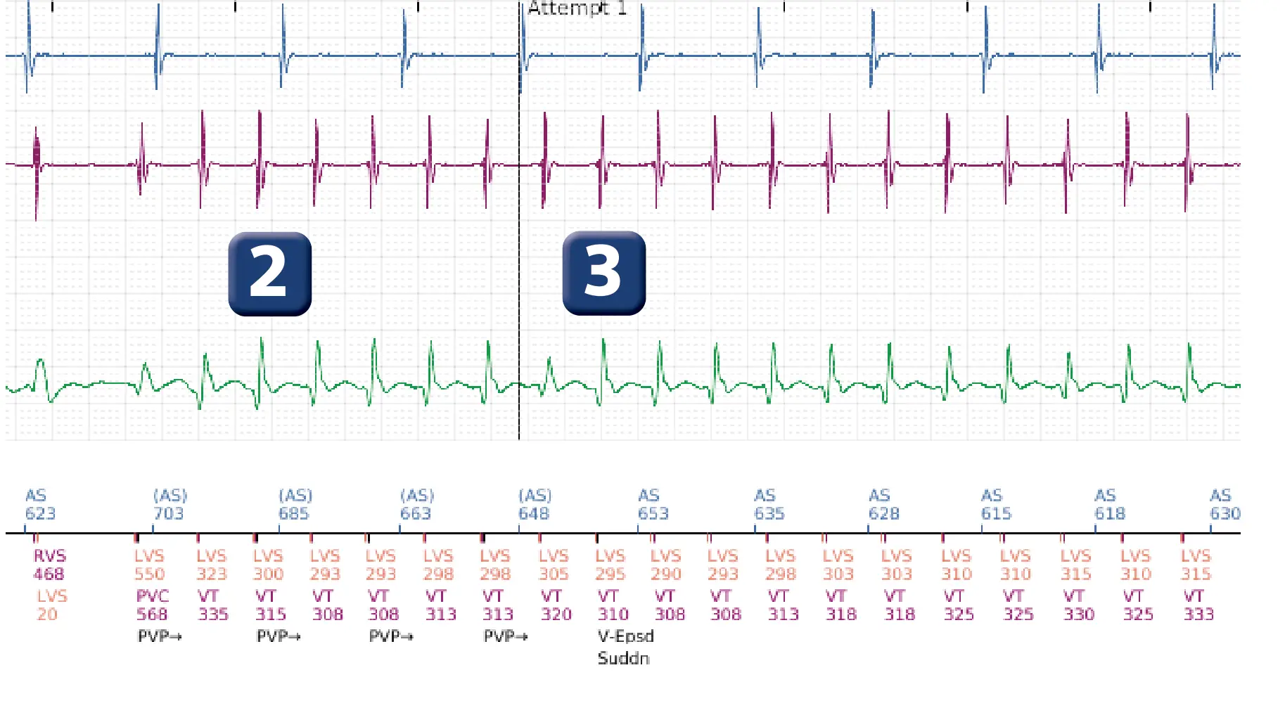 Boston Scientific ICD electrogram, segment 2 of 5 — Detection and treatment of a VT episode