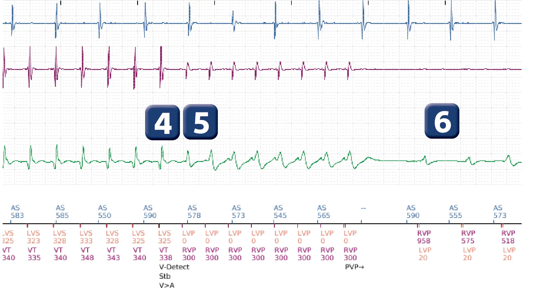 Boston Scientific ICD electrogram, segment 4 of 5 — Detection and treatment of a VT episode