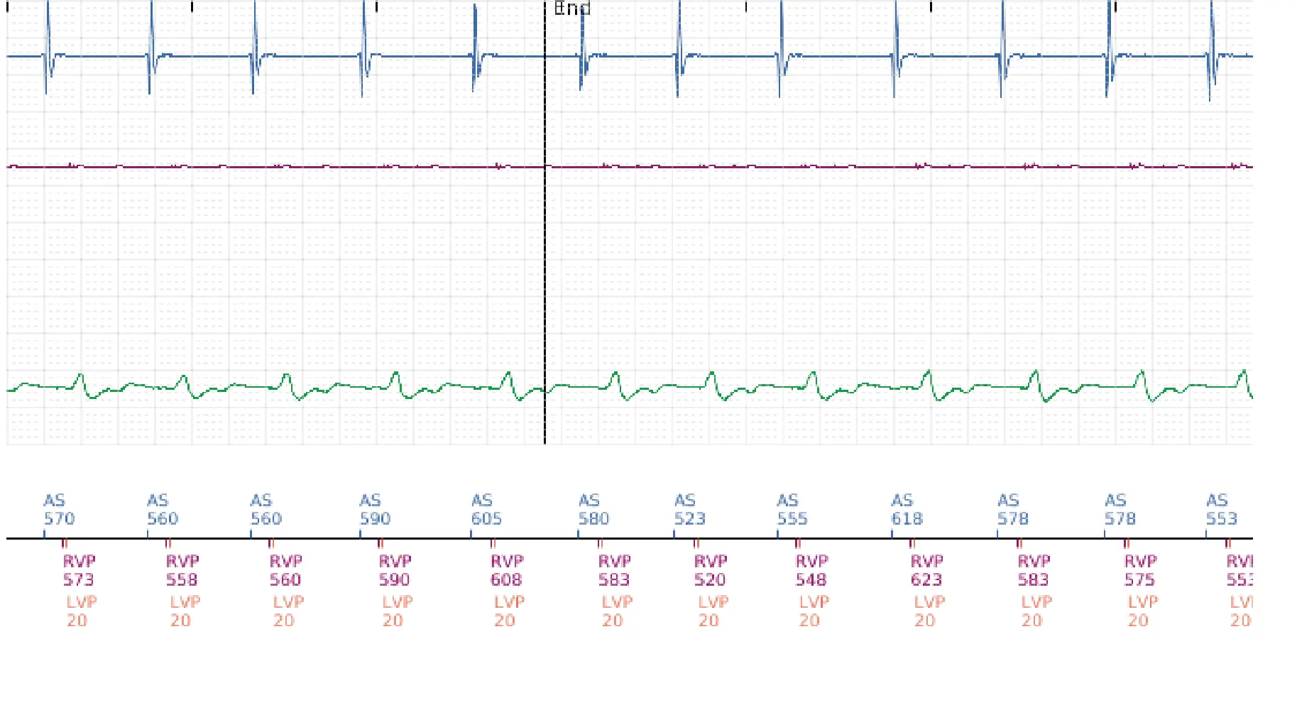 Boston Scientific ICD electrogram, segment 5 of 5 — Detection and treatment of a VT episode