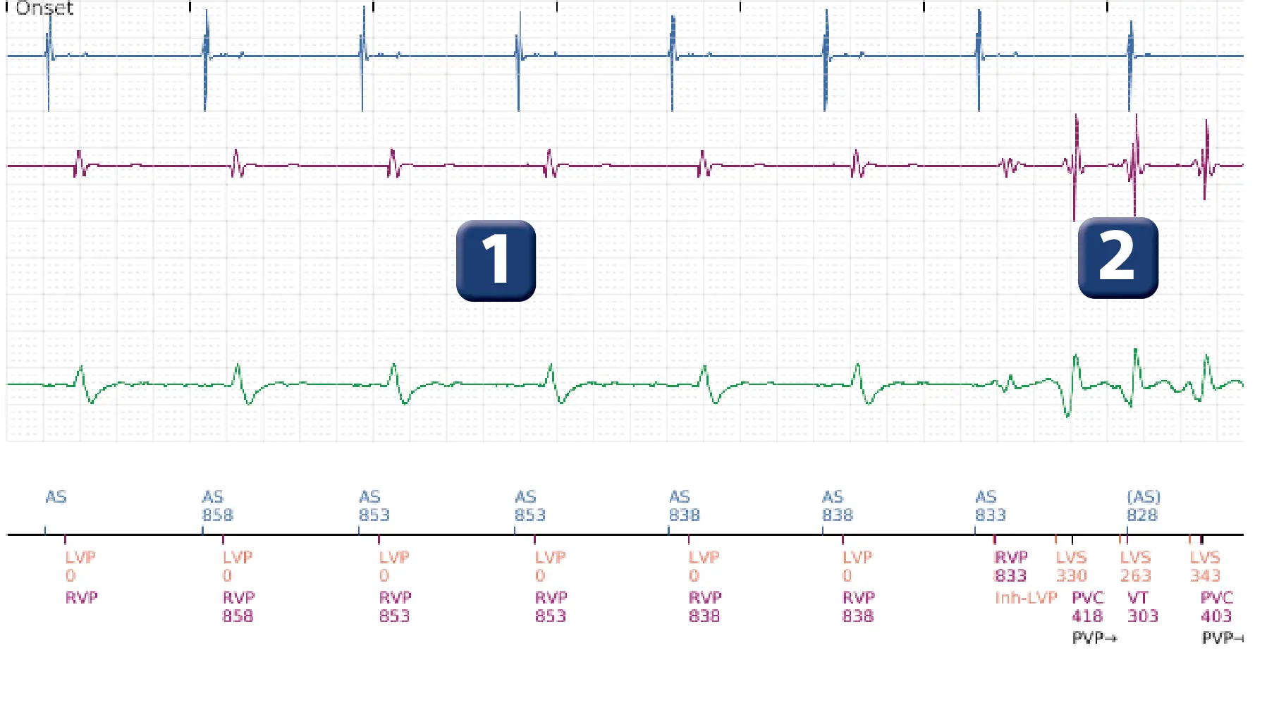 Boston Scientific ICD electrogram, segment 1 of 4 — Non-sustained ventricular tachycardia
