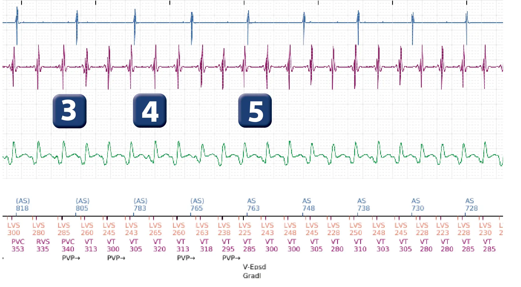 Boston Scientific ICD electrogram, segment 2 of 4 — Non-sustained ventricular tachycardia