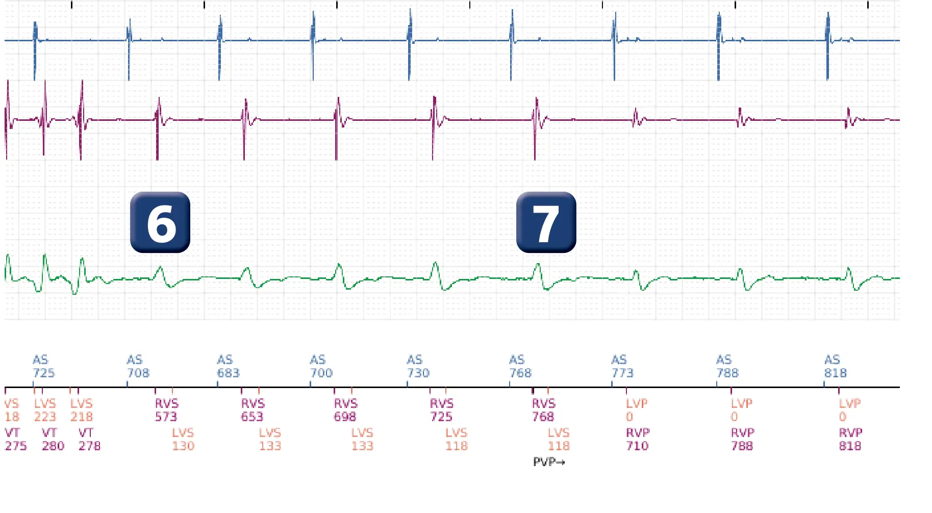 Boston Scientific ICD electrogram, segment 3 of 4 — Non-sustained ventricular tachycardia