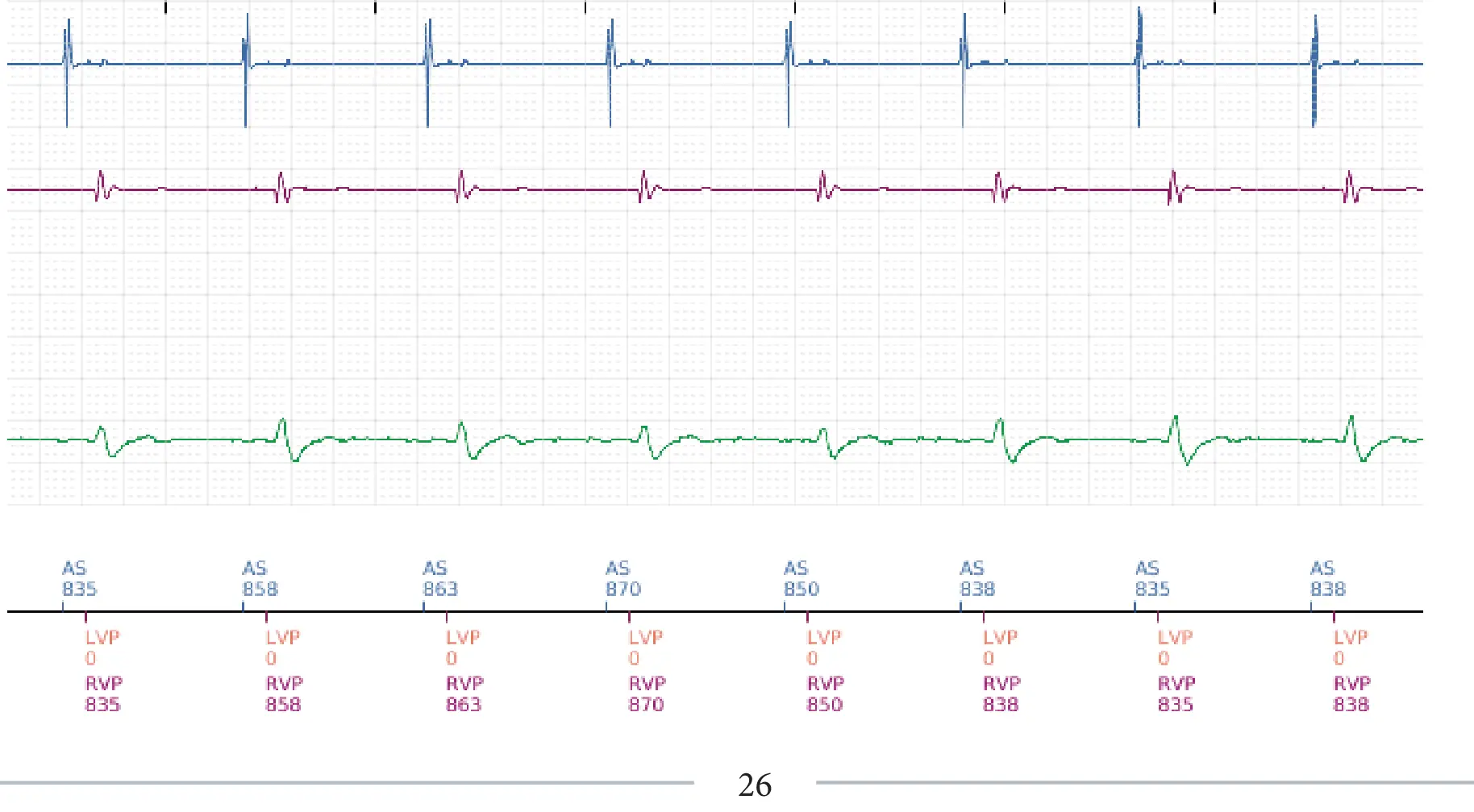 Boston Scientific ICD electrogram, segment 4 of 4 — Non-sustained ventricular tachycardia