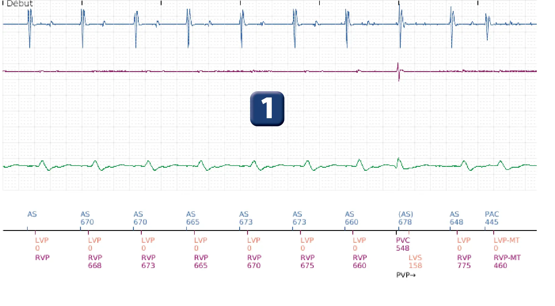 Boston Scientific ICD electrogram, segment 1 of 6 — Change of detection zone