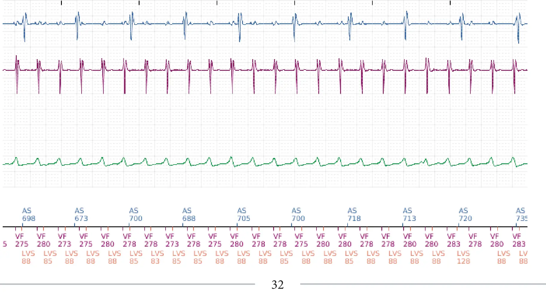 Boston Scientific ICD electrogram, segment 4 of 6 — Change of detection zone