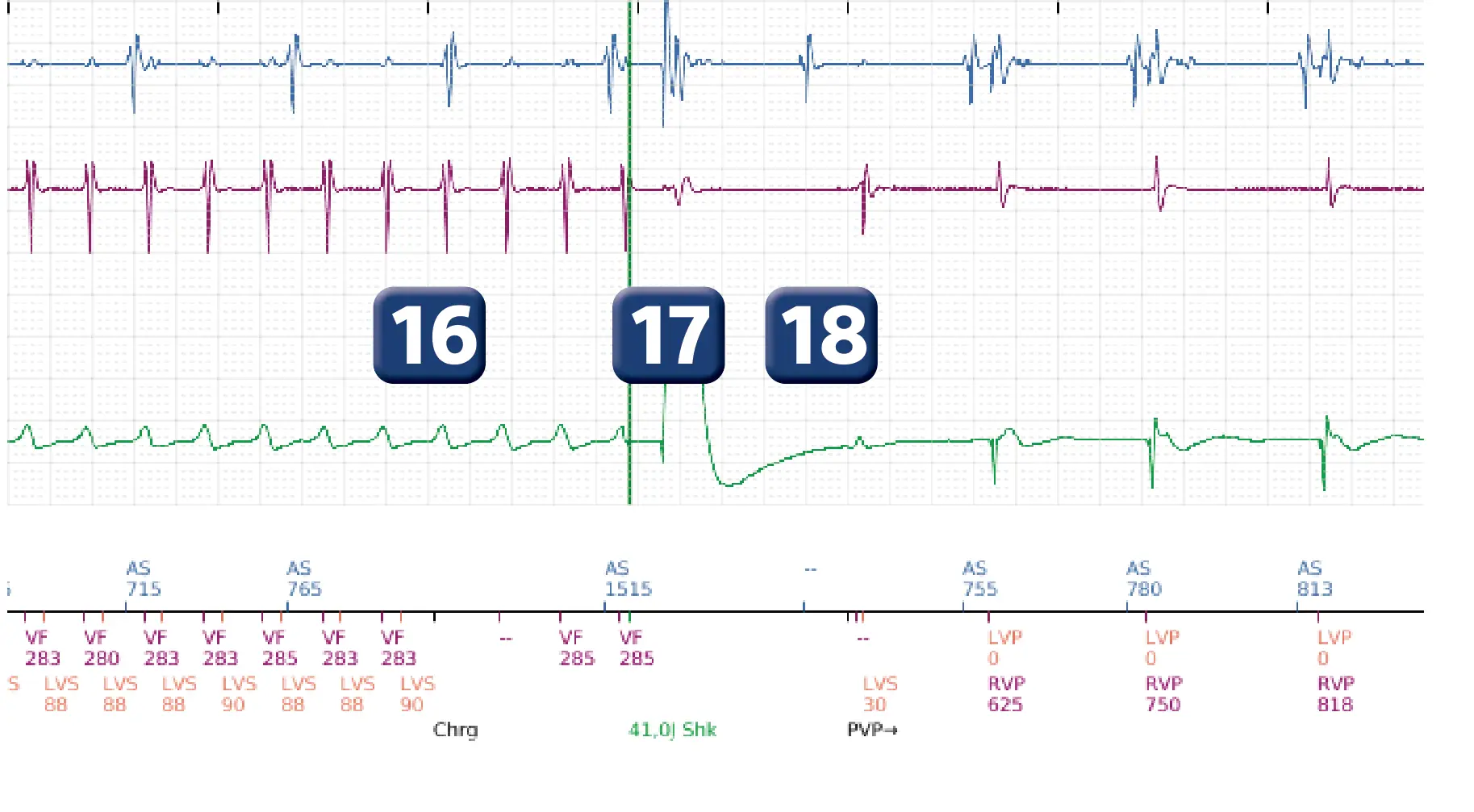 Boston Scientific ICD electrogram, segment 5 of 6 — Change of detection zone