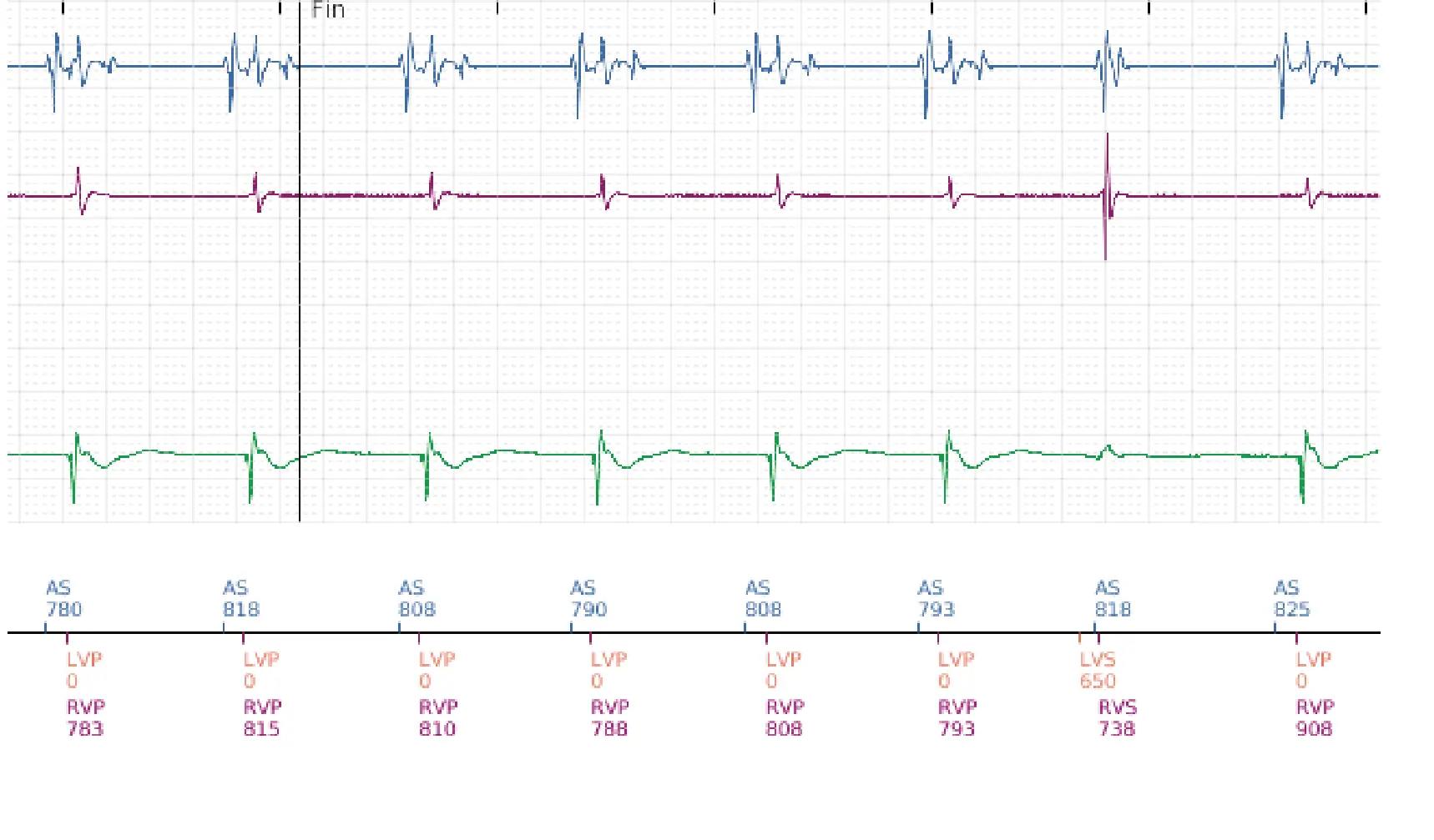 Boston Scientific ICD electrogram, segment 6 of 6 — Change of detection zone