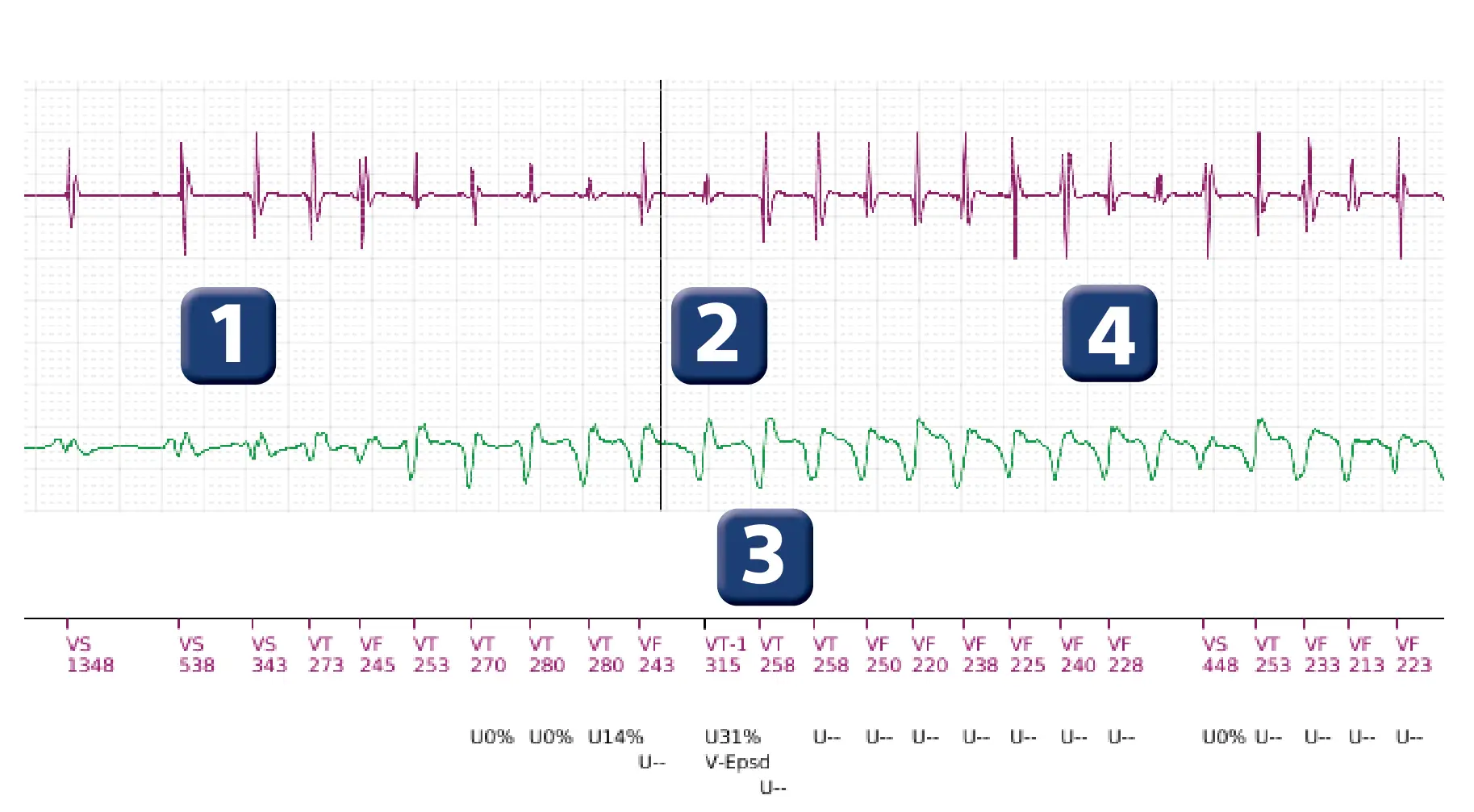 Boston Scientific ICD electrogram, segment 2 of 4 — Spontaneous termination and shock diversion
