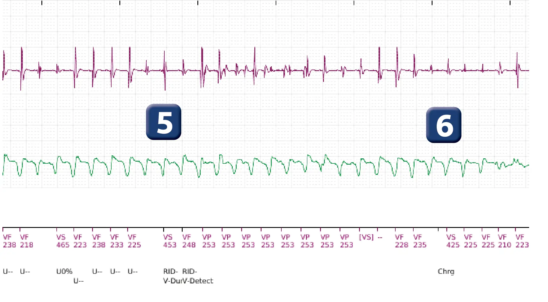 Boston Scientific ICD electrogram, segment 3 of 4 — Spontaneous termination and shock diversion