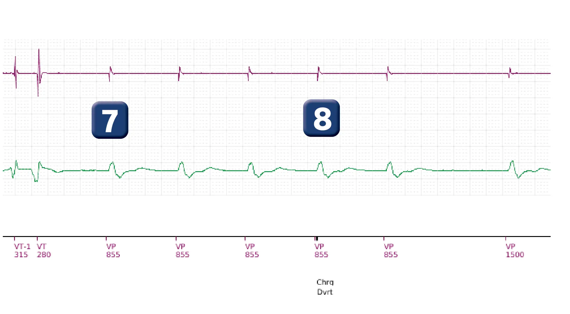 Boston Scientific ICD electrogram, segment 4 of 4 — Spontaneous termination and shock diversion