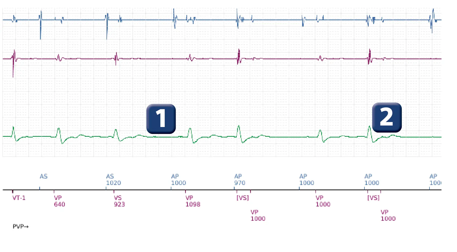 Boston Scientific ICD electrogram, segment 1 of 5 — Spontaneous termination and shock diversion