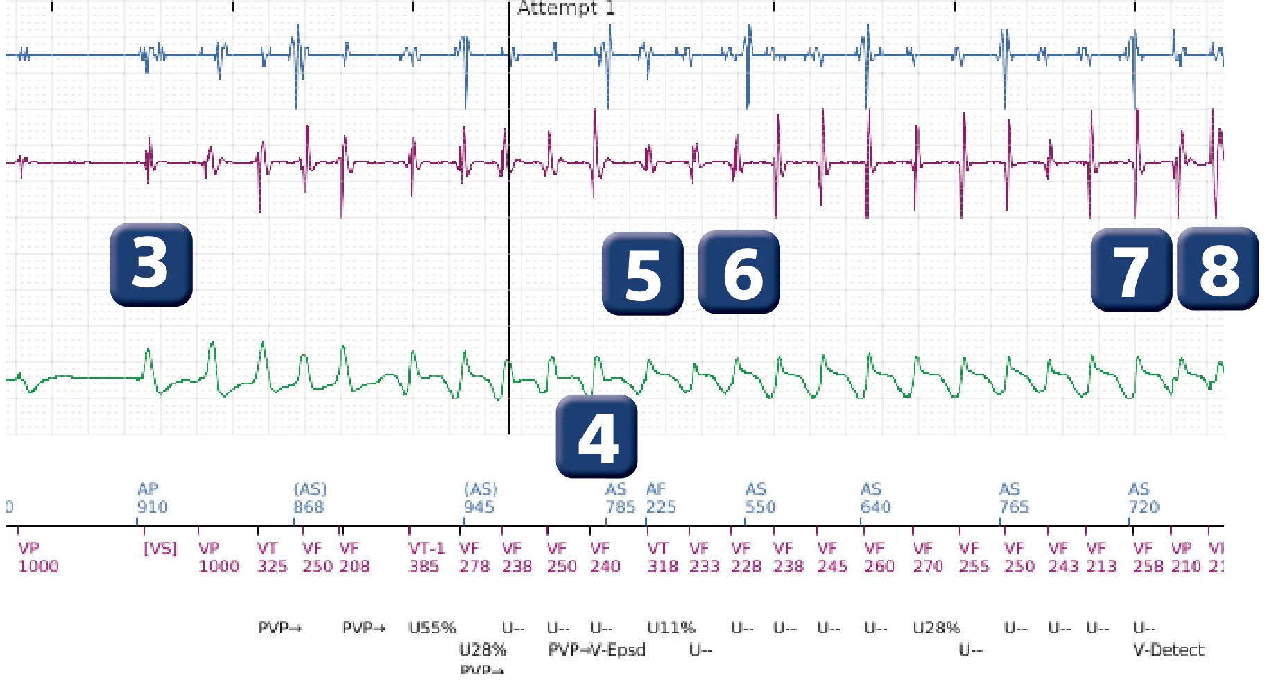 Boston Scientific ICD electrogram, segment 2 of 5 — Spontaneous termination and shock diversion