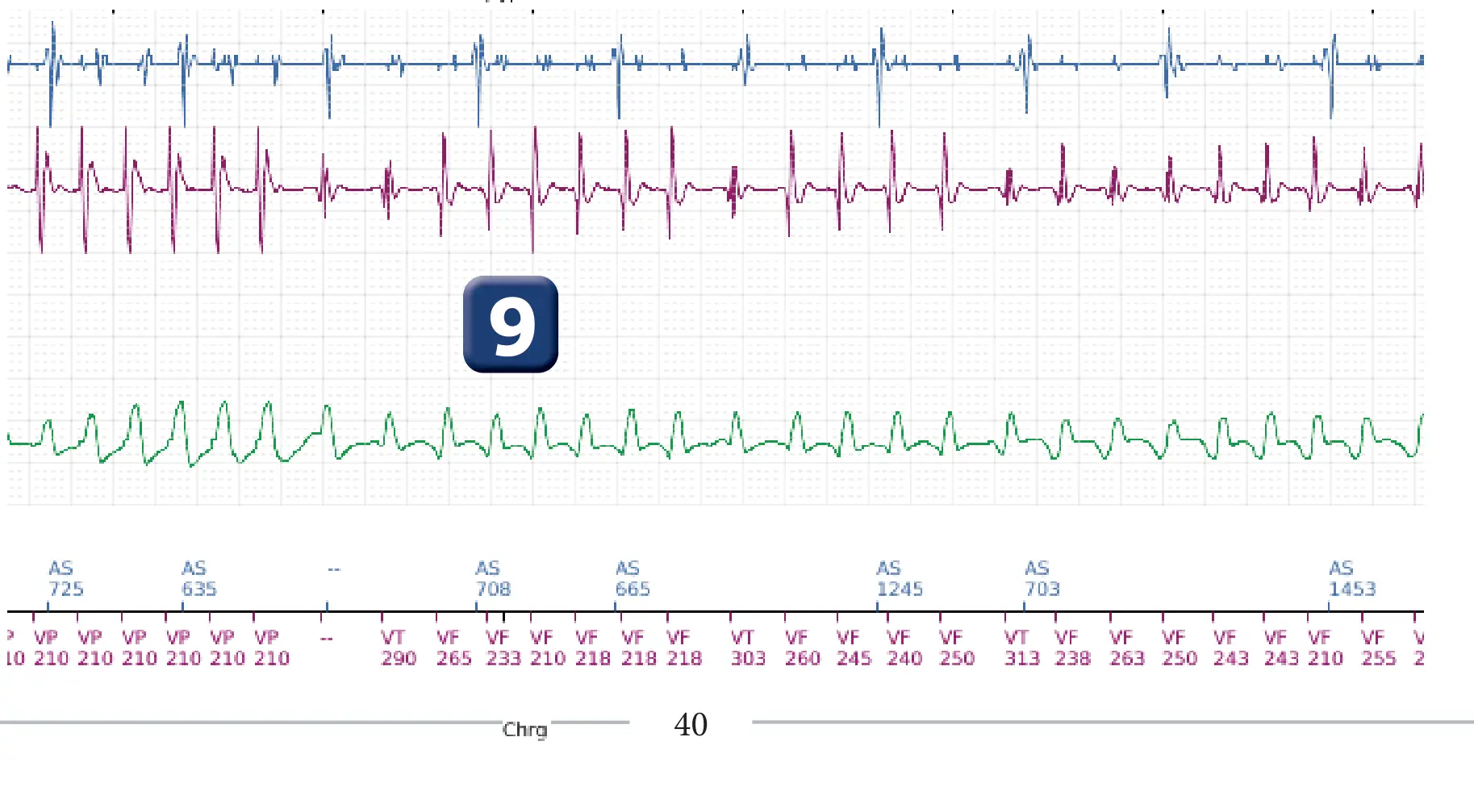 Boston Scientific ICD electrogram, segment 3 of 5 — Spontaneous termination and shock diversion