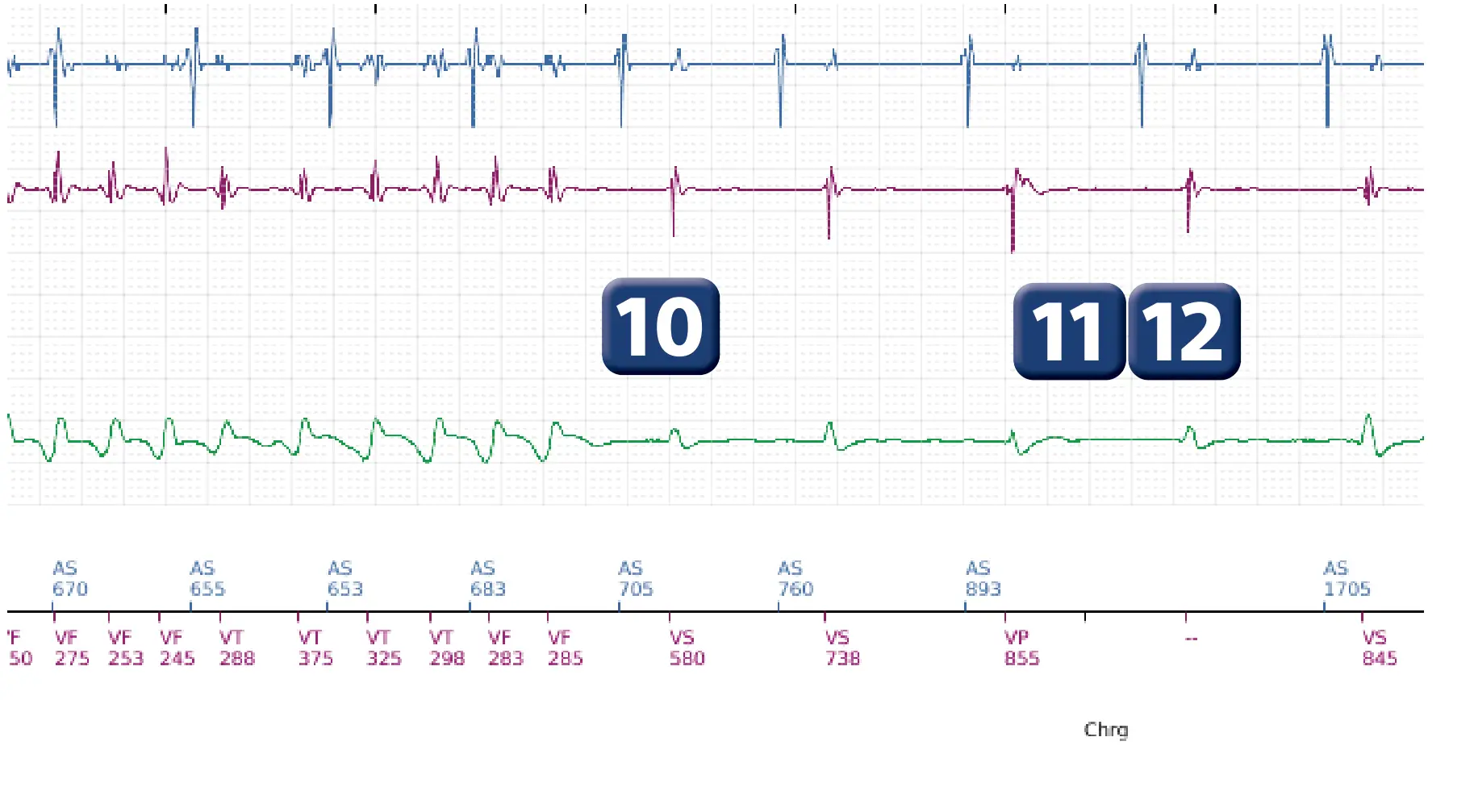 Boston Scientific ICD electrogram, segment 4 of 5 — Spontaneous termination and shock diversion