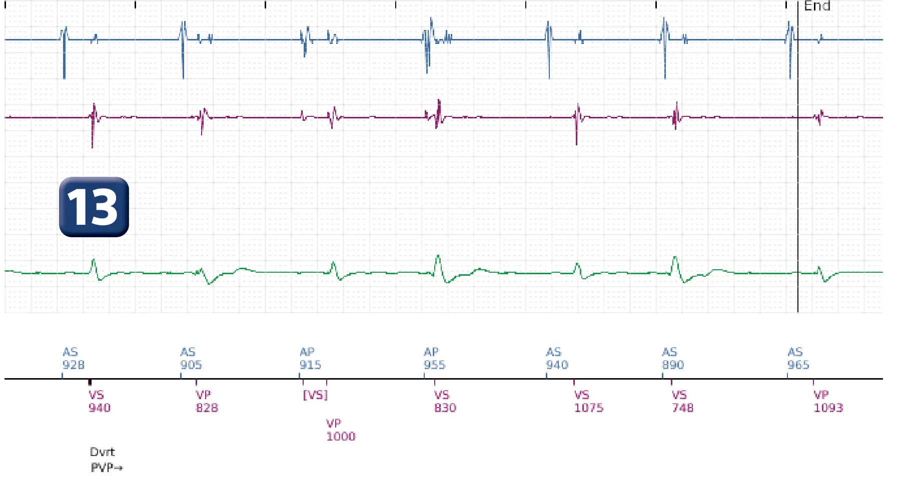 Boston Scientific ICD electrogram, segment 5 of 5 — Spontaneous termination and shock diversion