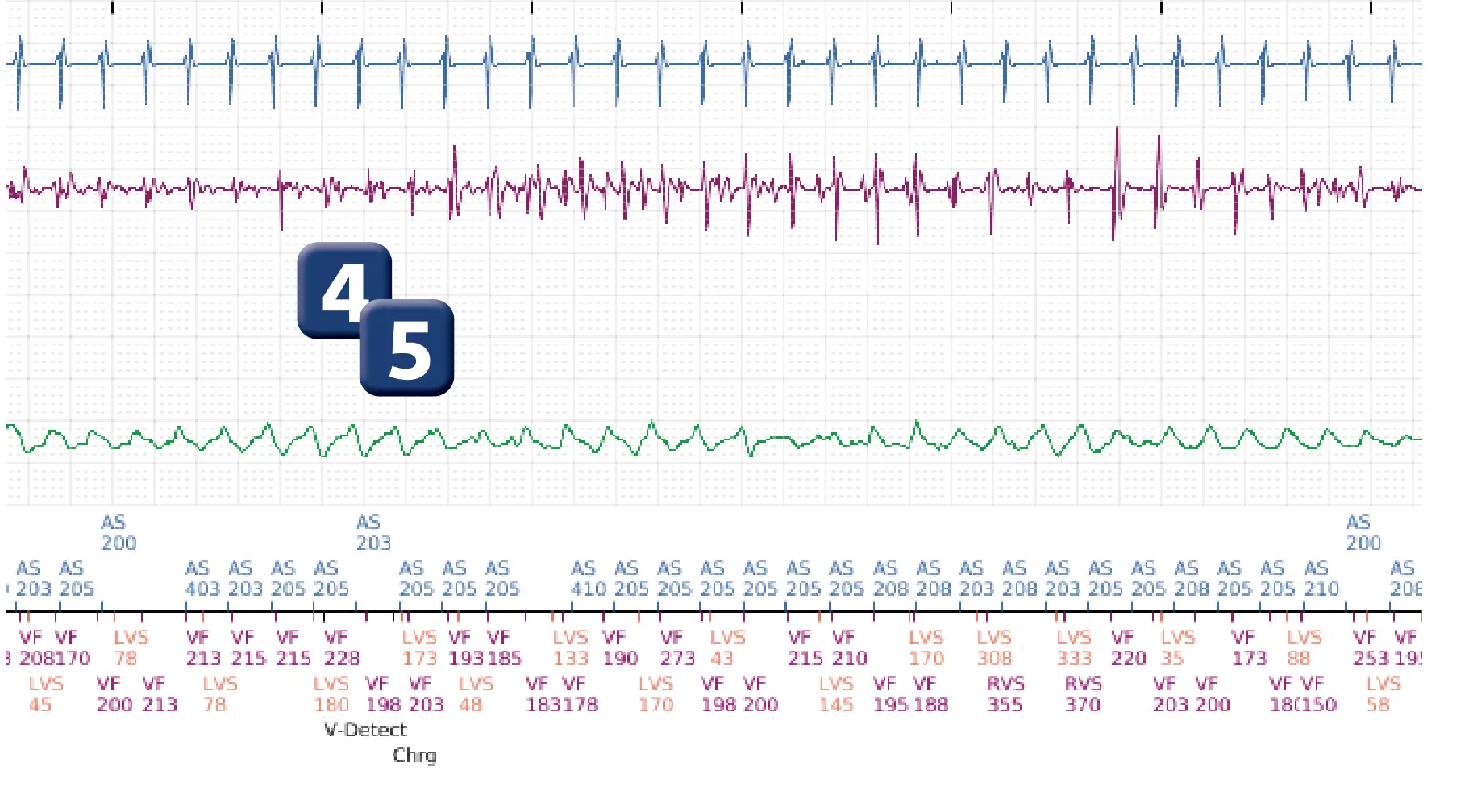 Boston Scientific ICD electrogram, segment 2 of 4 — Diversion window at end of a charge