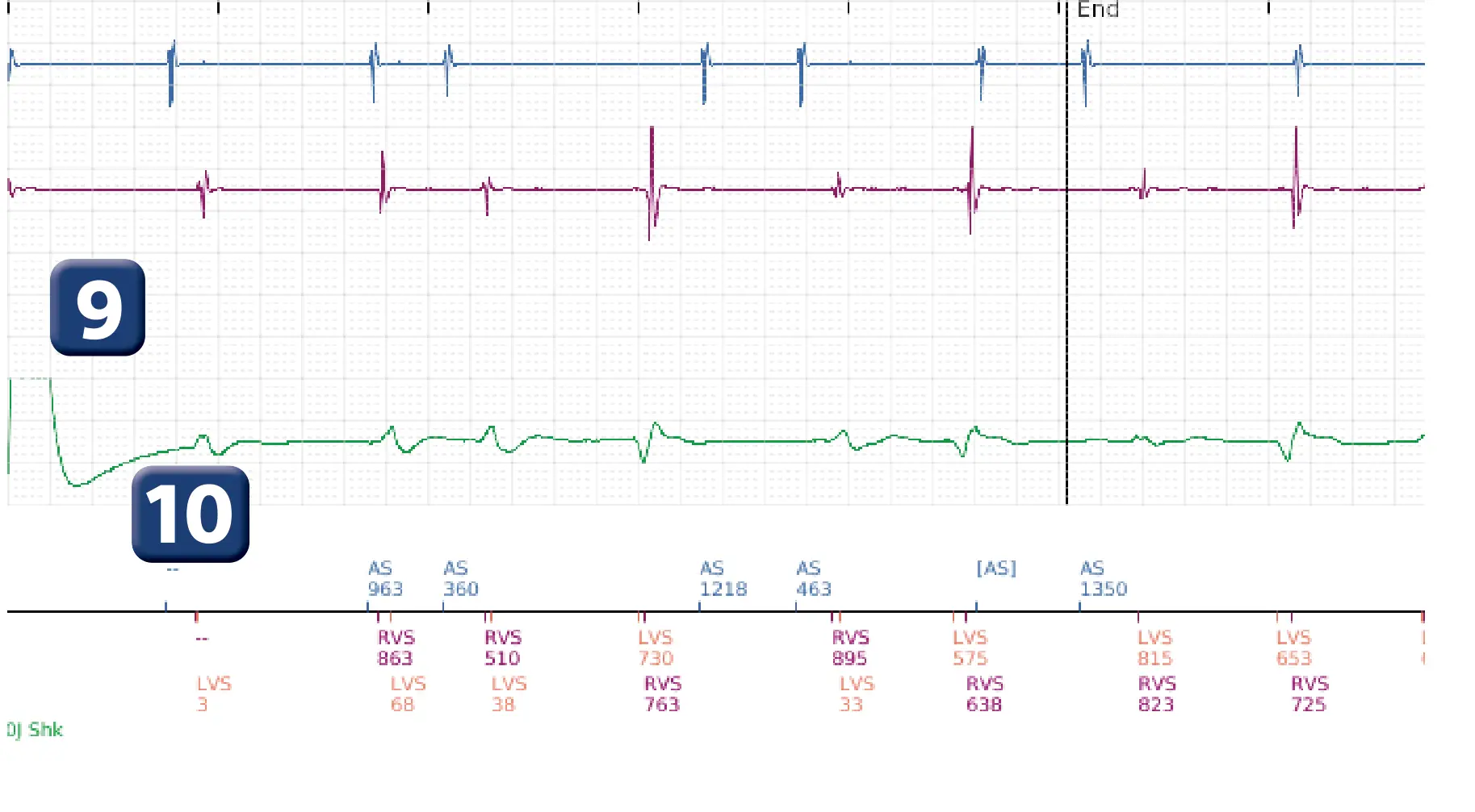 Boston Scientific ICD electrogram, segment 4 of 4 — Diversion window at end of a charge