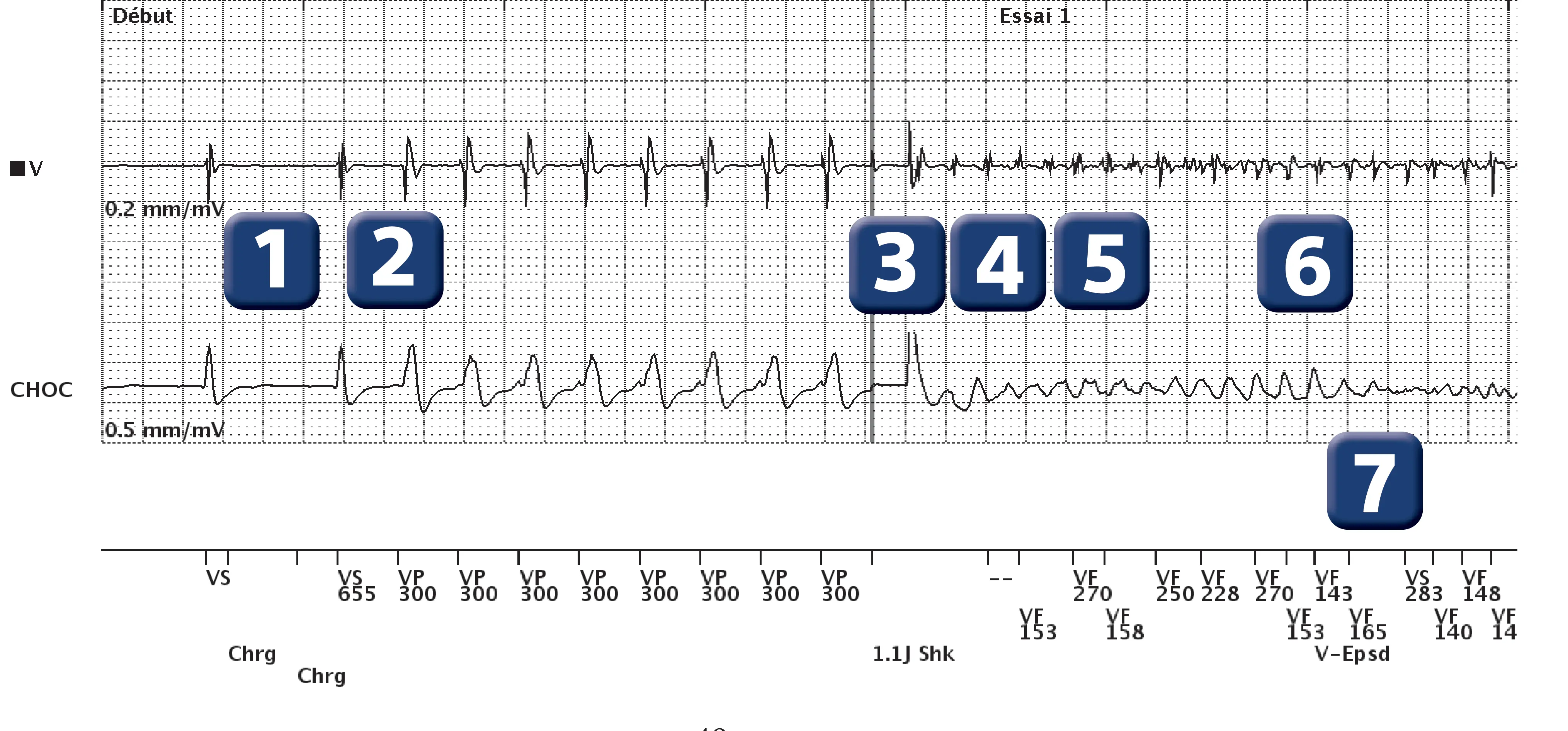 Boston Scientific ICD electrogram, segment 1 of 3 — Undersensing and charge diversion