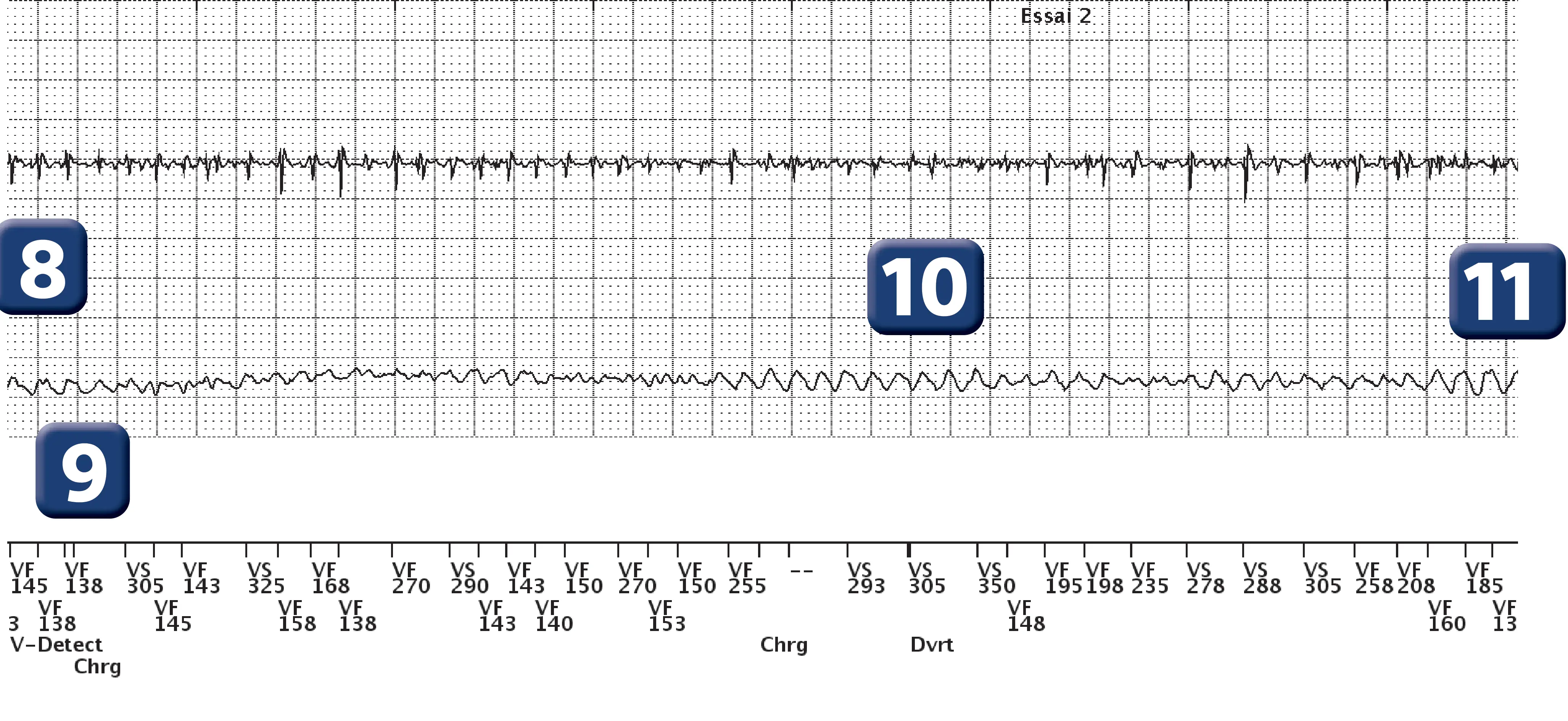 Boston Scientific ICD electrogram, segment 2 of 3 — Undersensing and charge diversion