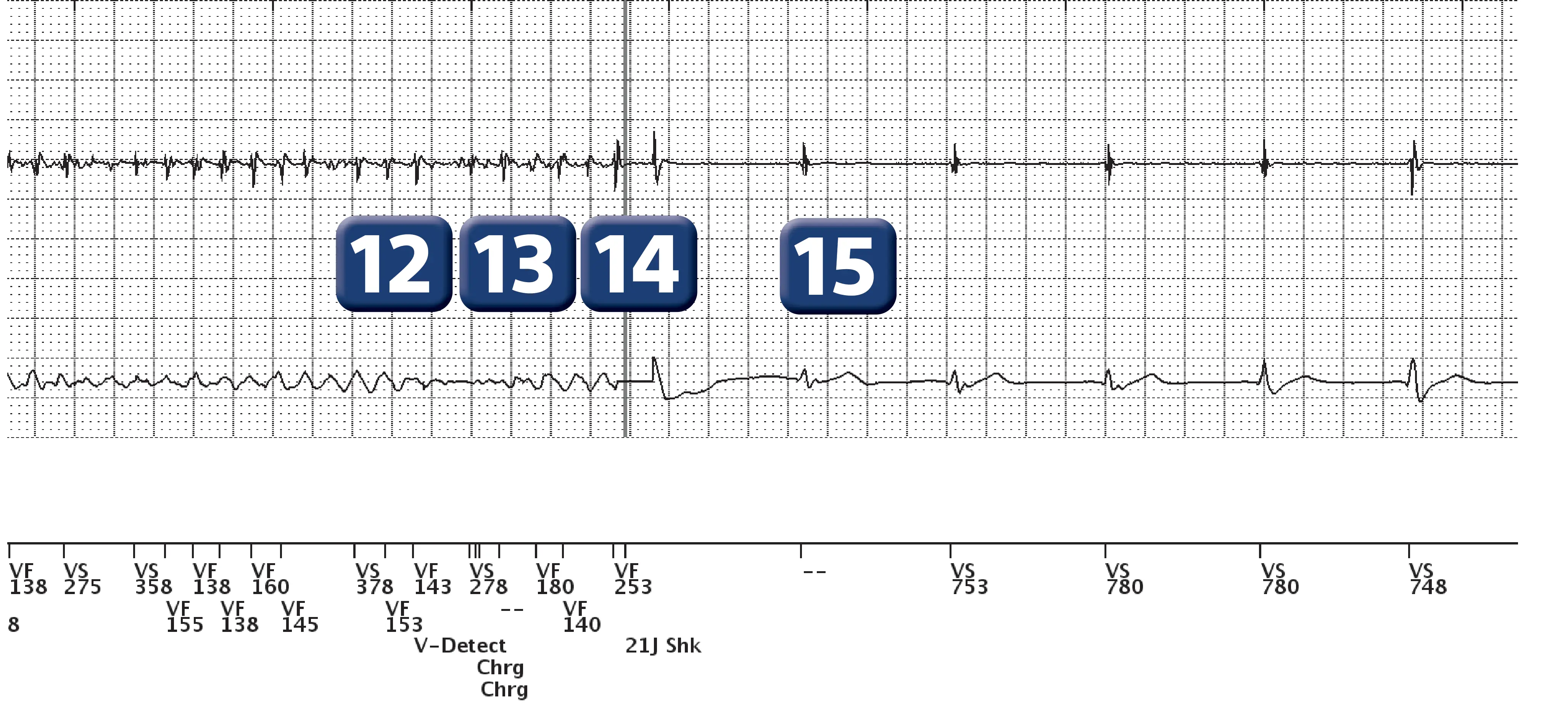 Boston Scientific ICD electrogram, segment 3 of 3 — Undersensing and charge diversion