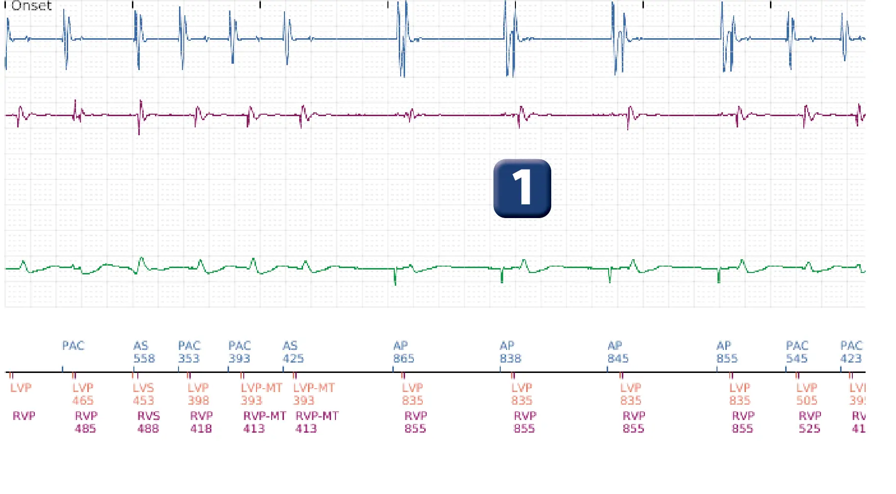 Boston Scientific ICD electrogram, segment 1 of 17 — End-of-episode criteria following an electric shock