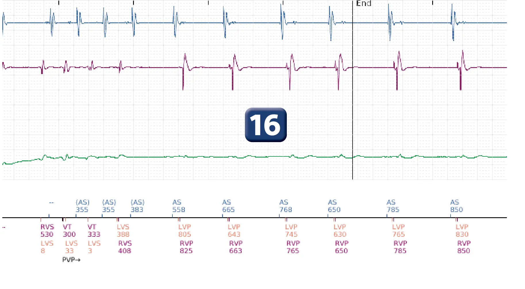 Boston Scientific ICD electrogram, segment 10 of 17 — End-of-episode criteria following an electric shock