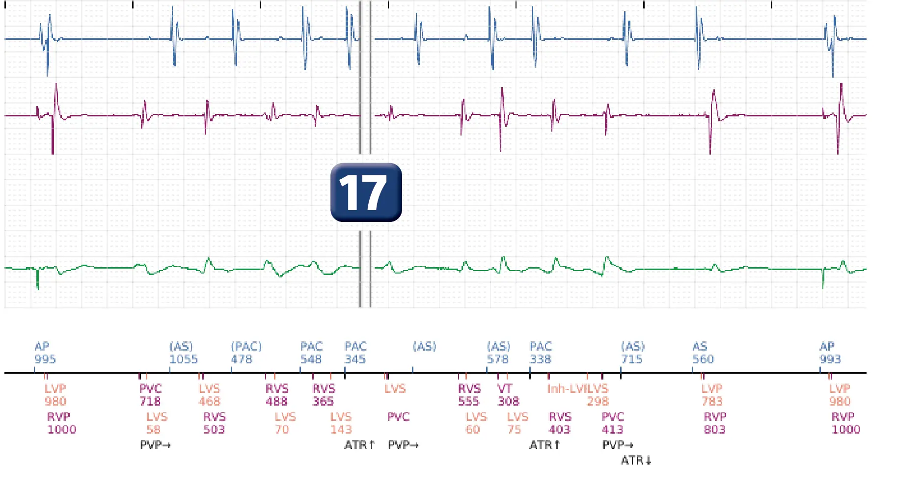 Boston Scientific ICD electrogram, segment 11 of 17 — End-of-episode criteria following an electric shock
