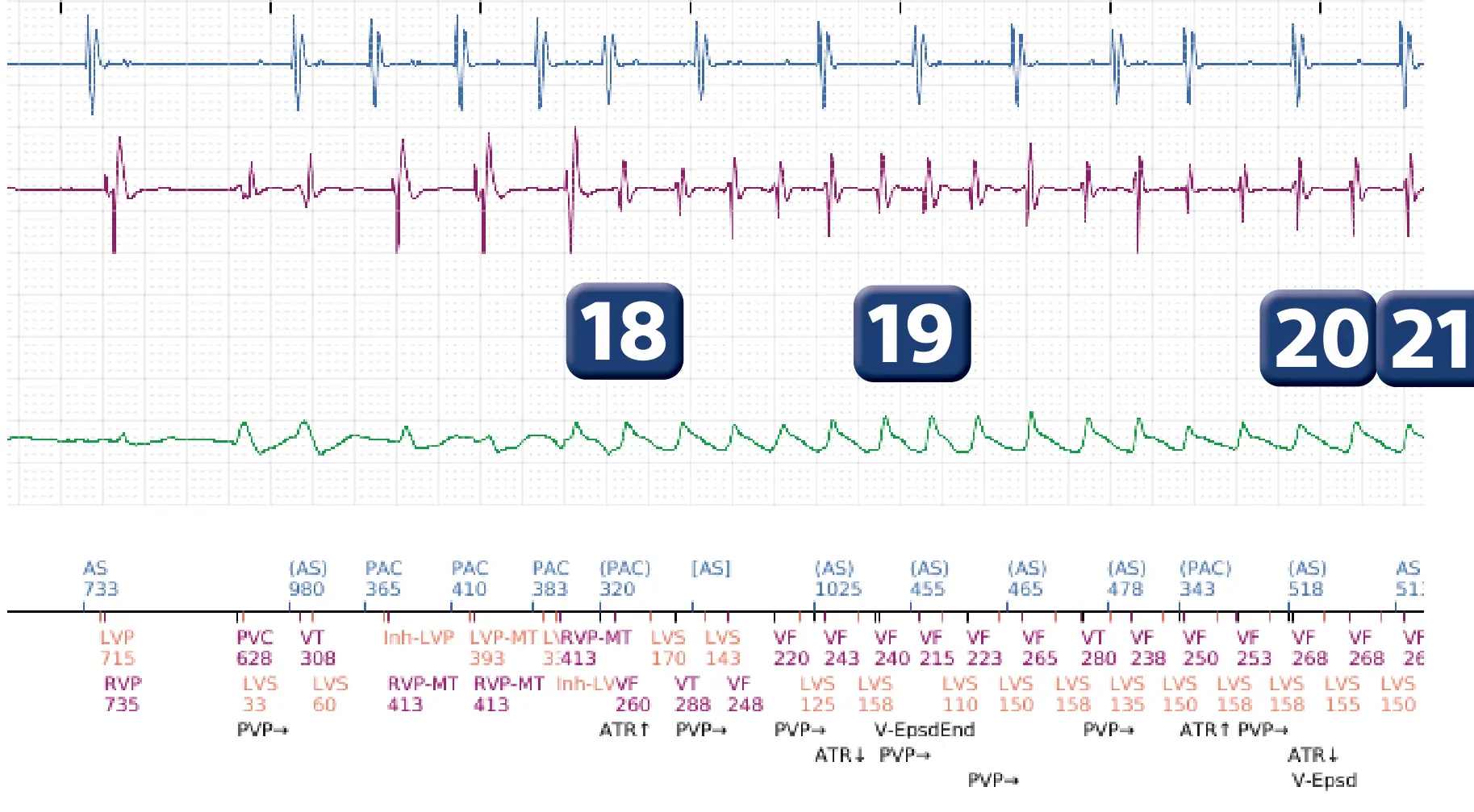 Boston Scientific ICD electrogram, segment 12 of 17 — End-of-episode criteria following an electric shock