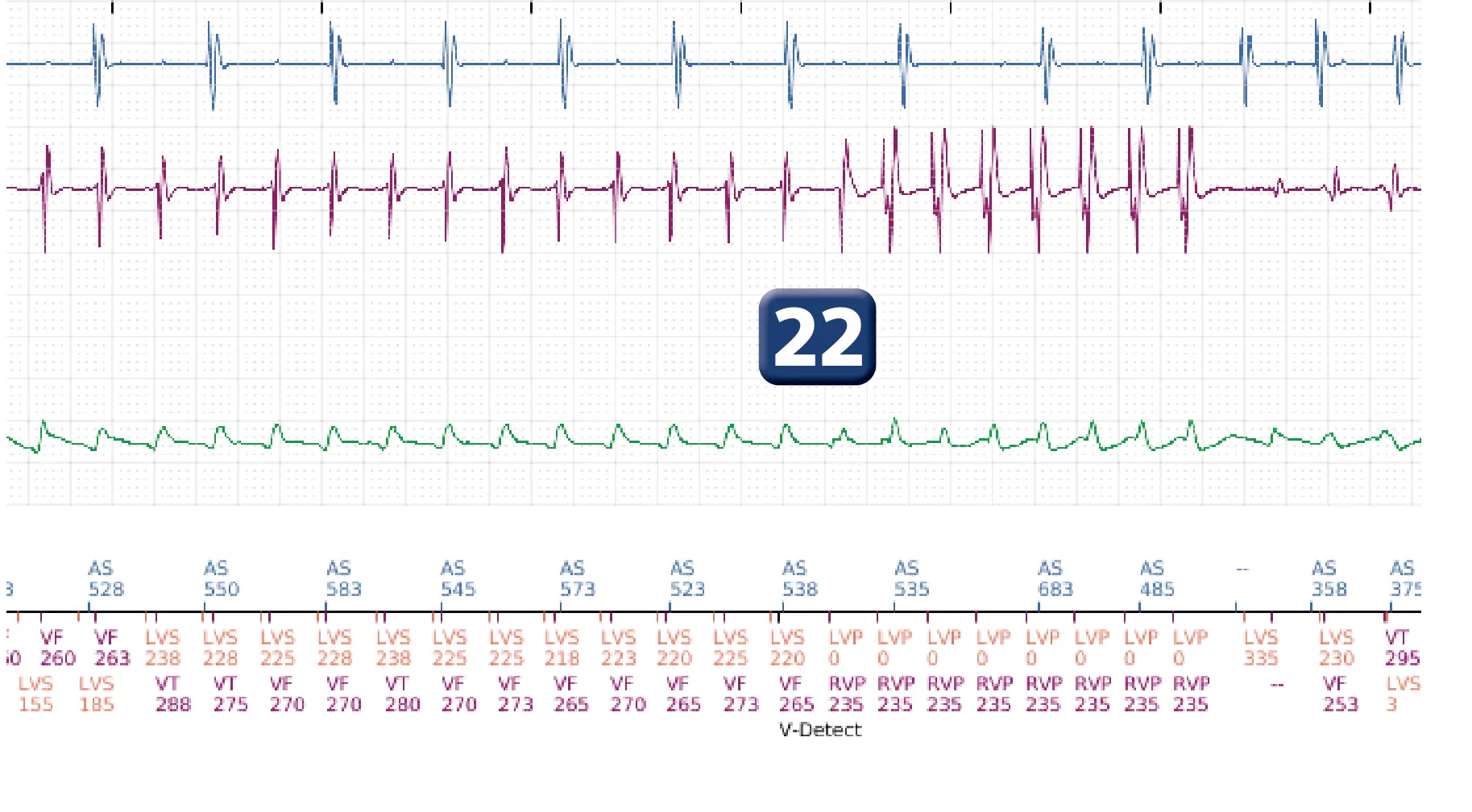 Boston Scientific ICD electrogram, segment 13 of 17 — End-of-episode criteria following an electric shock