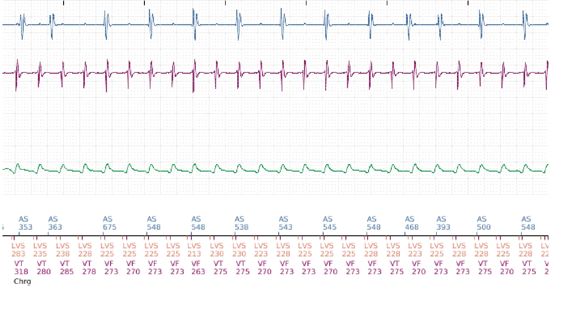 Boston Scientific ICD electrogram, segment 14 of 17 — End-of-episode criteria following an electric shock