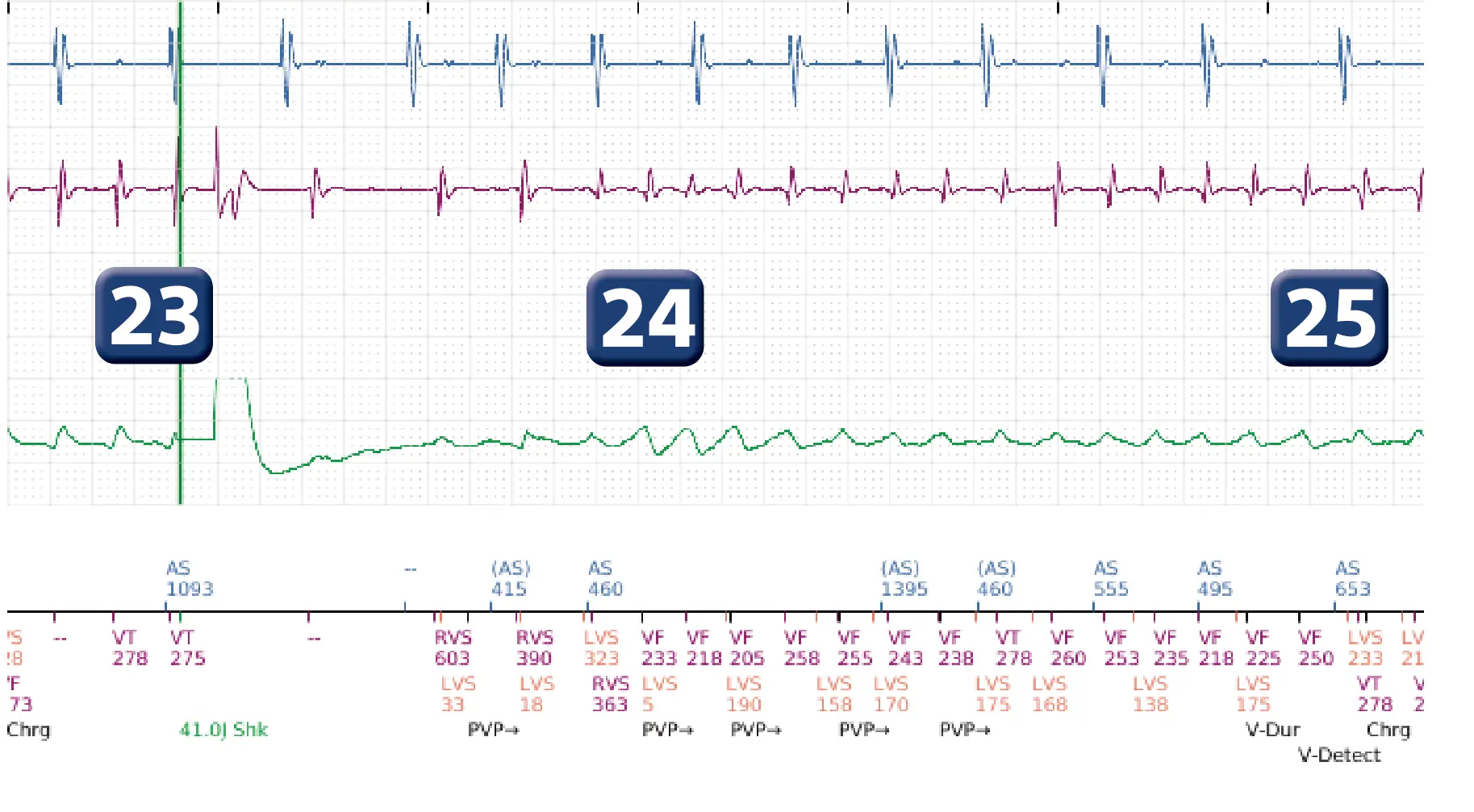 Boston Scientific ICD electrogram, segment 15 of 17 — End-of-episode criteria following an electric shock