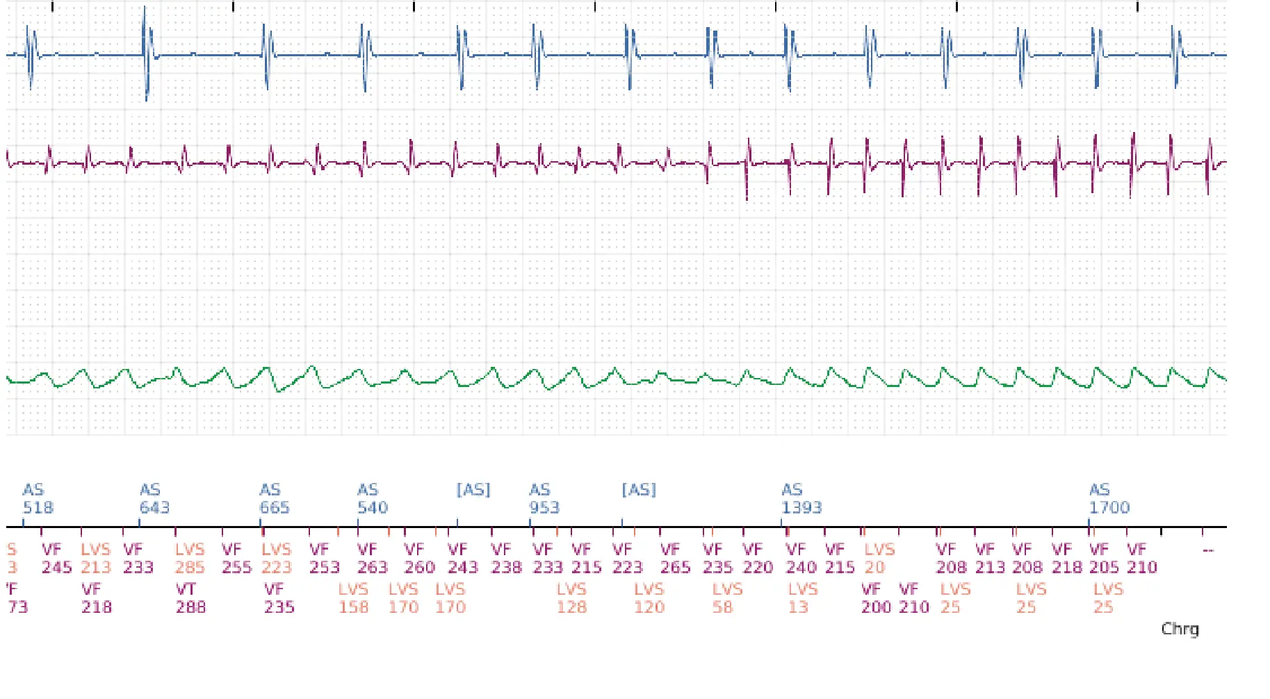 Boston Scientific ICD electrogram, segment 16 of 17 — End-of-episode criteria following an electric shock