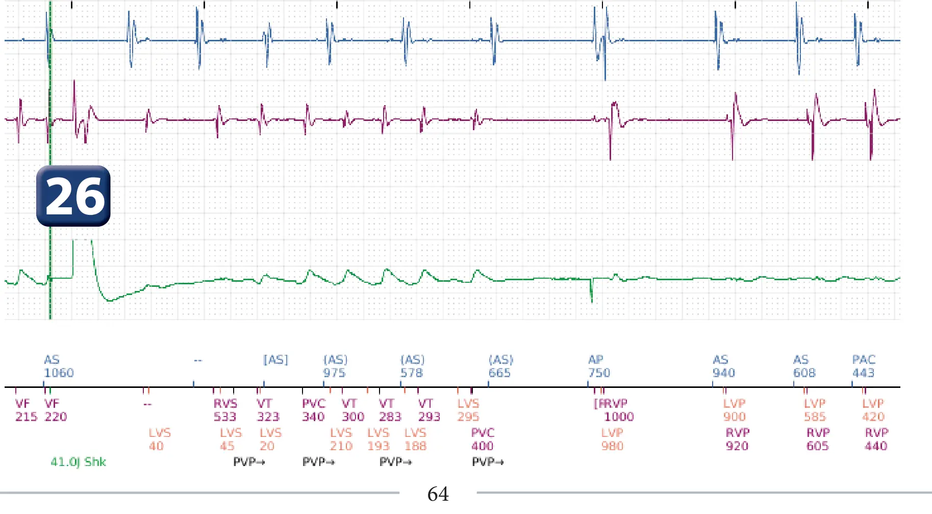 Boston Scientific ICD electrogram, segment 17 of 17 — End-of-episode criteria following an electric shock