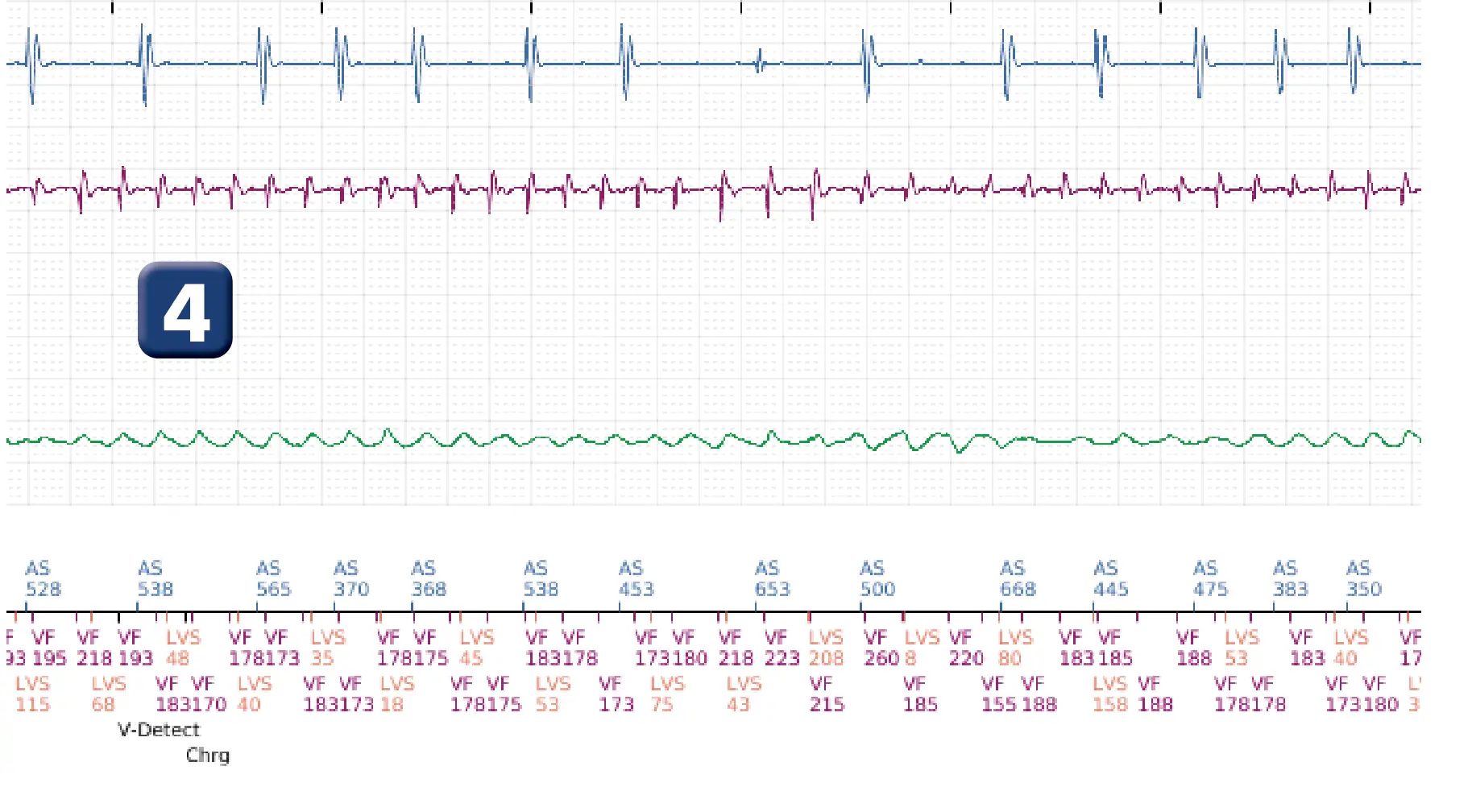Boston Scientific ICD electrogram, segment 3 of 17 — End-of-episode criteria following an electric shock