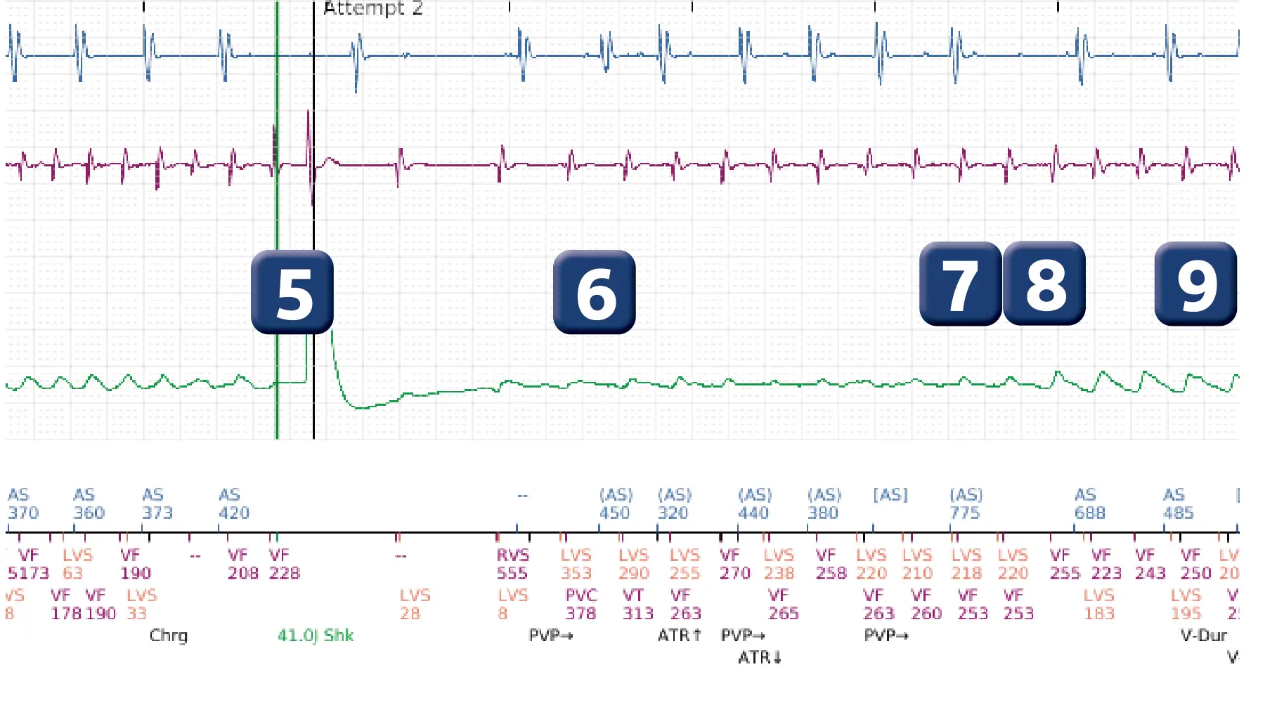 Boston Scientific ICD electrogram, segment 4 of 17 — End-of-episode criteria following an electric shock