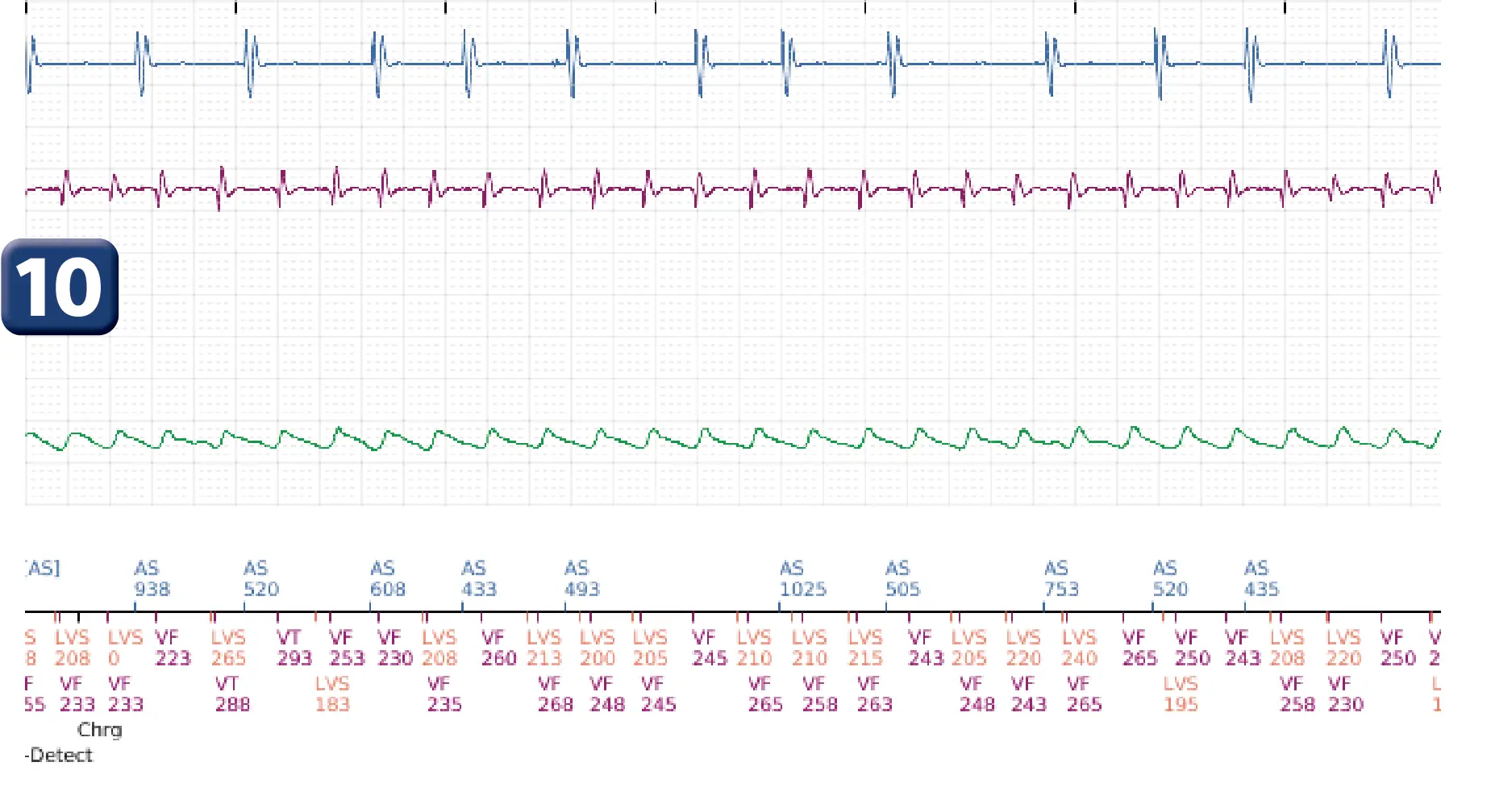 Boston Scientific ICD electrogram, segment 5 of 17 — End-of-episode criteria following an electric shock