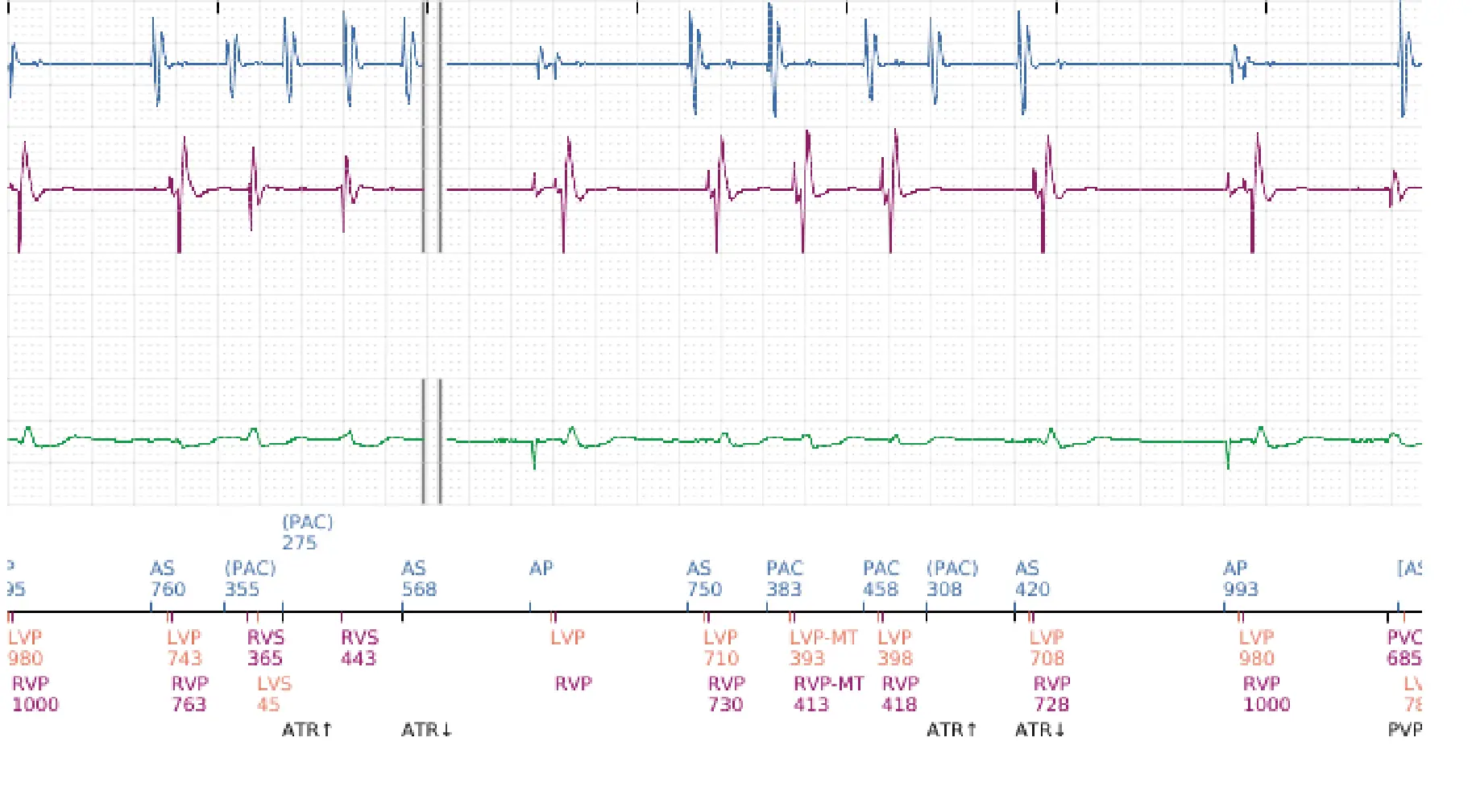 Boston Scientific ICD electrogram, segment 7 of 17 — End-of-episode criteria following an electric shock