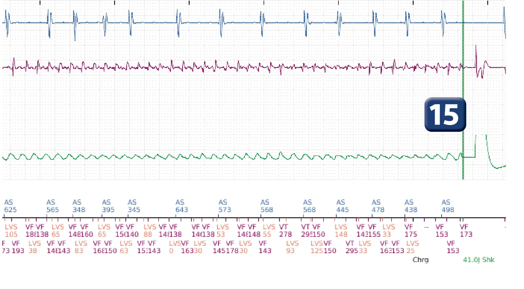 Boston Scientific ICD electrogram, segment 9 of 17 — End-of-episode criteria following an electric shock