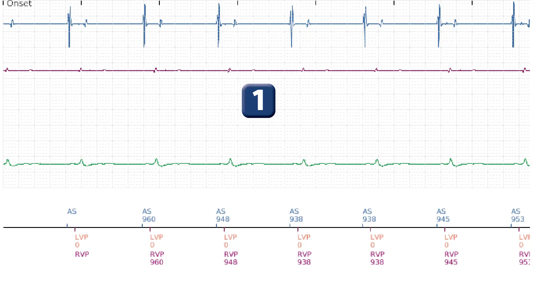 Boston Scientific ICD electrogram, segment 1 of 5 — VF episode correctly detected and treated with maximum output shock