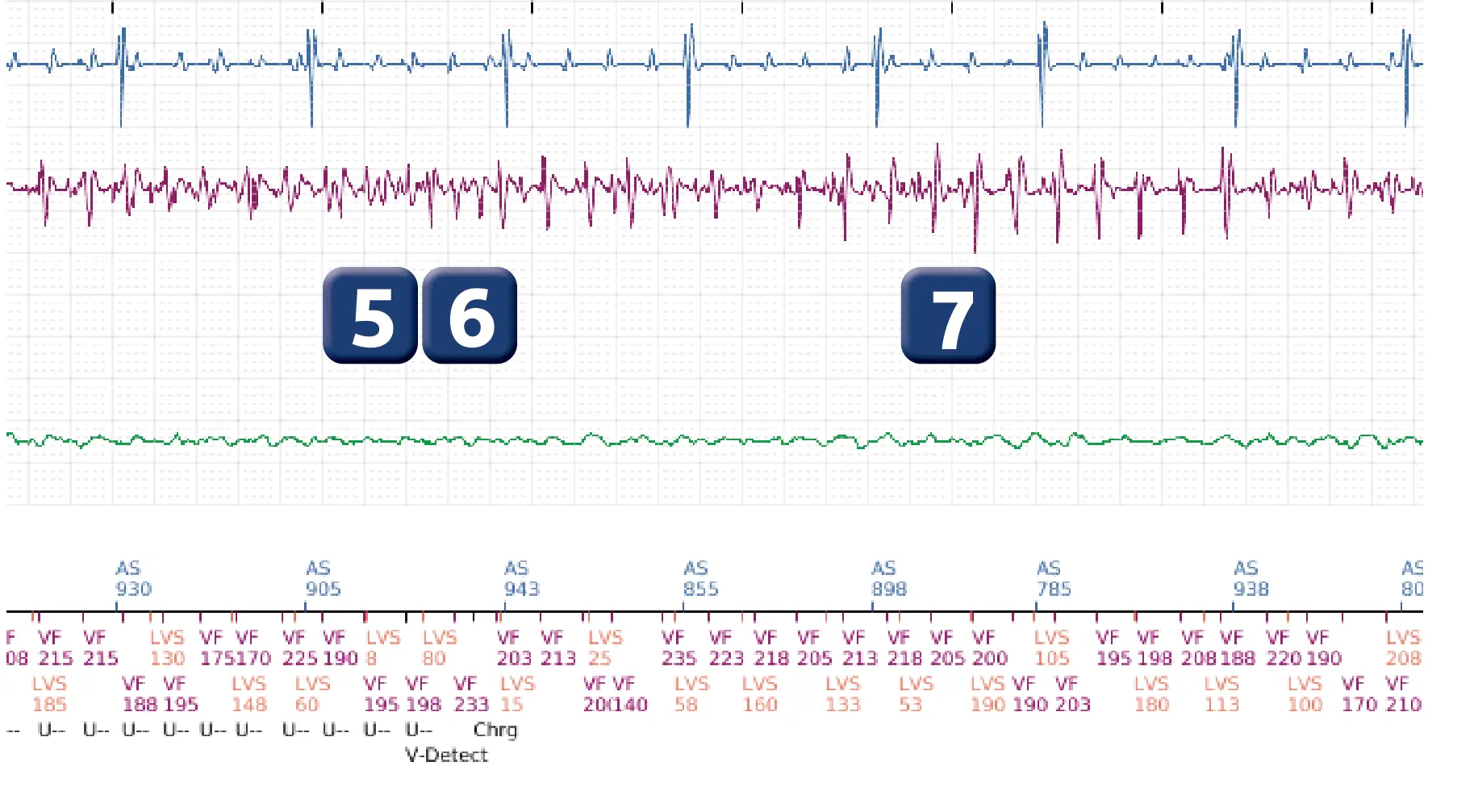 Boston Scientific ICD electrogram, segment 3 of 5 — VF episode correctly detected and treated with maximum output shock