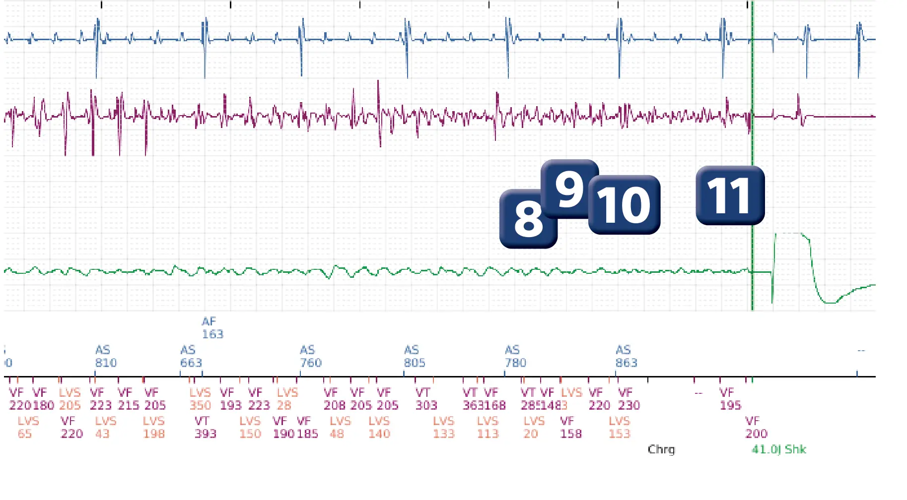 Boston Scientific ICD electrogram, segment 4 of 5 — VF episode correctly detected and treated with maximum output shock