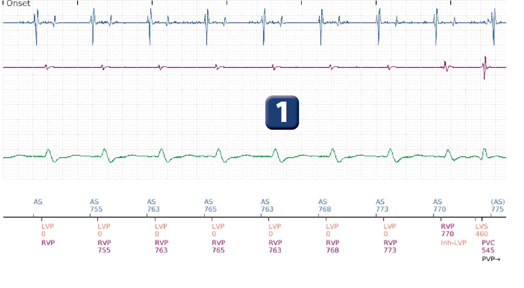 Boston Scientific ICD electrogram, segment 1 of 5 — Anti-tachycardia pacing in the VT zone