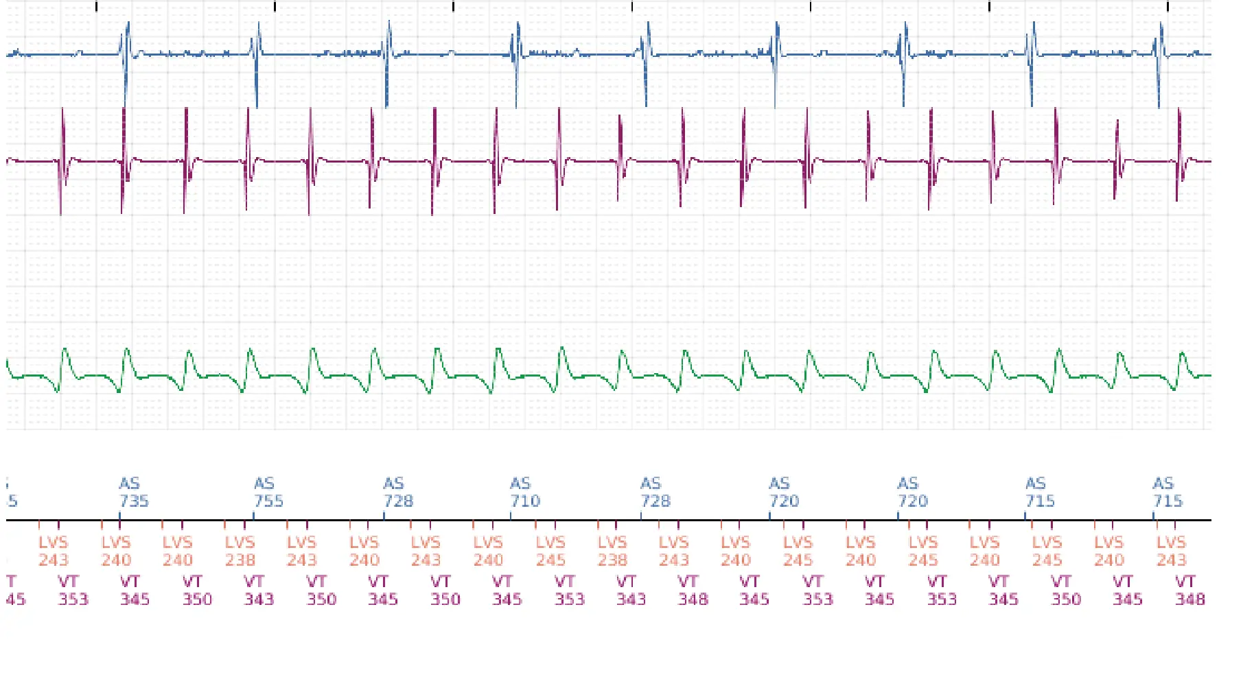 Boston Scientific ICD electrogram, segment 3 of 5 — Anti-tachycardia pacing in the VT zone