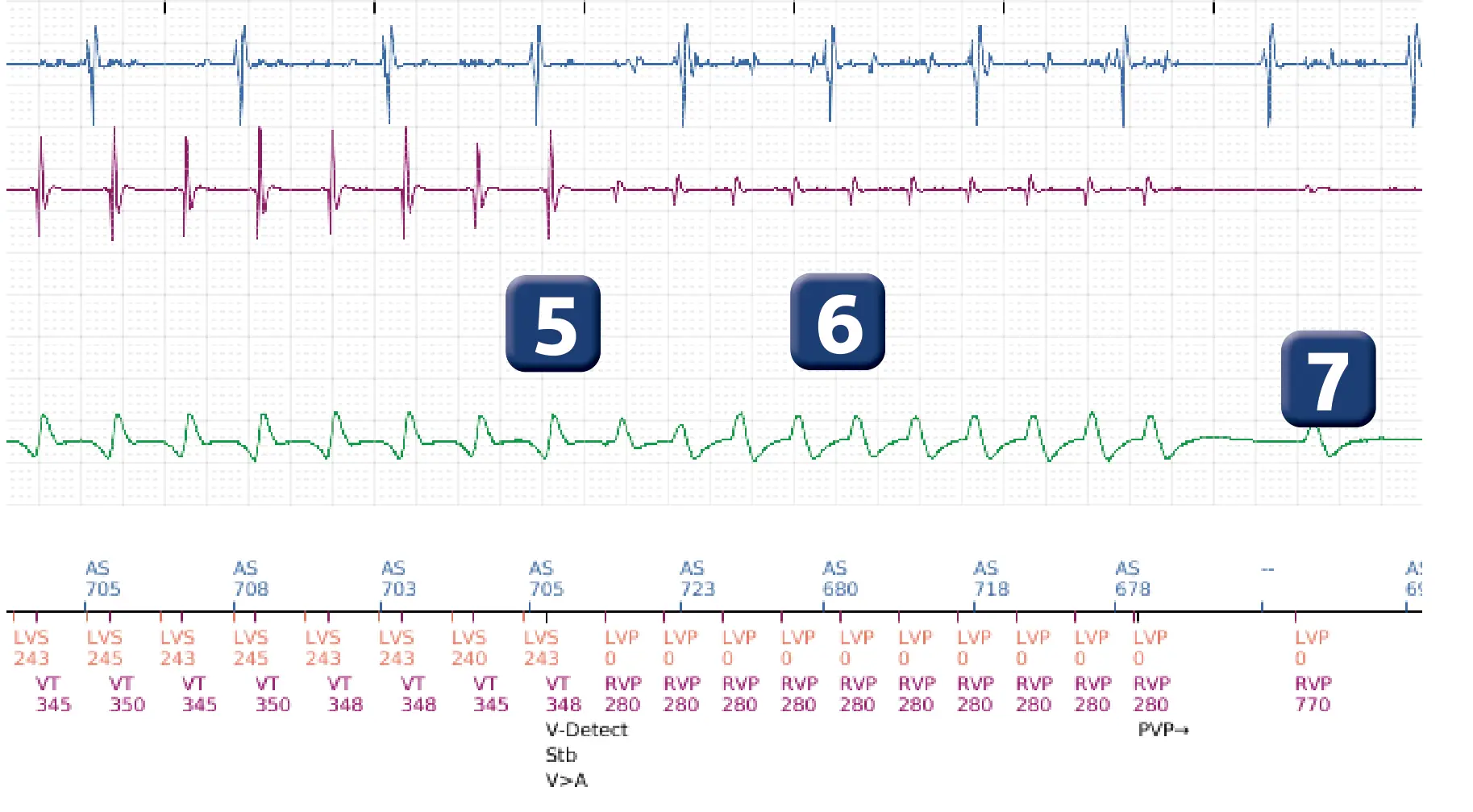 Boston Scientific ICD electrogram, segment 4 of 5 — Anti-tachycardia pacing in the VT zone