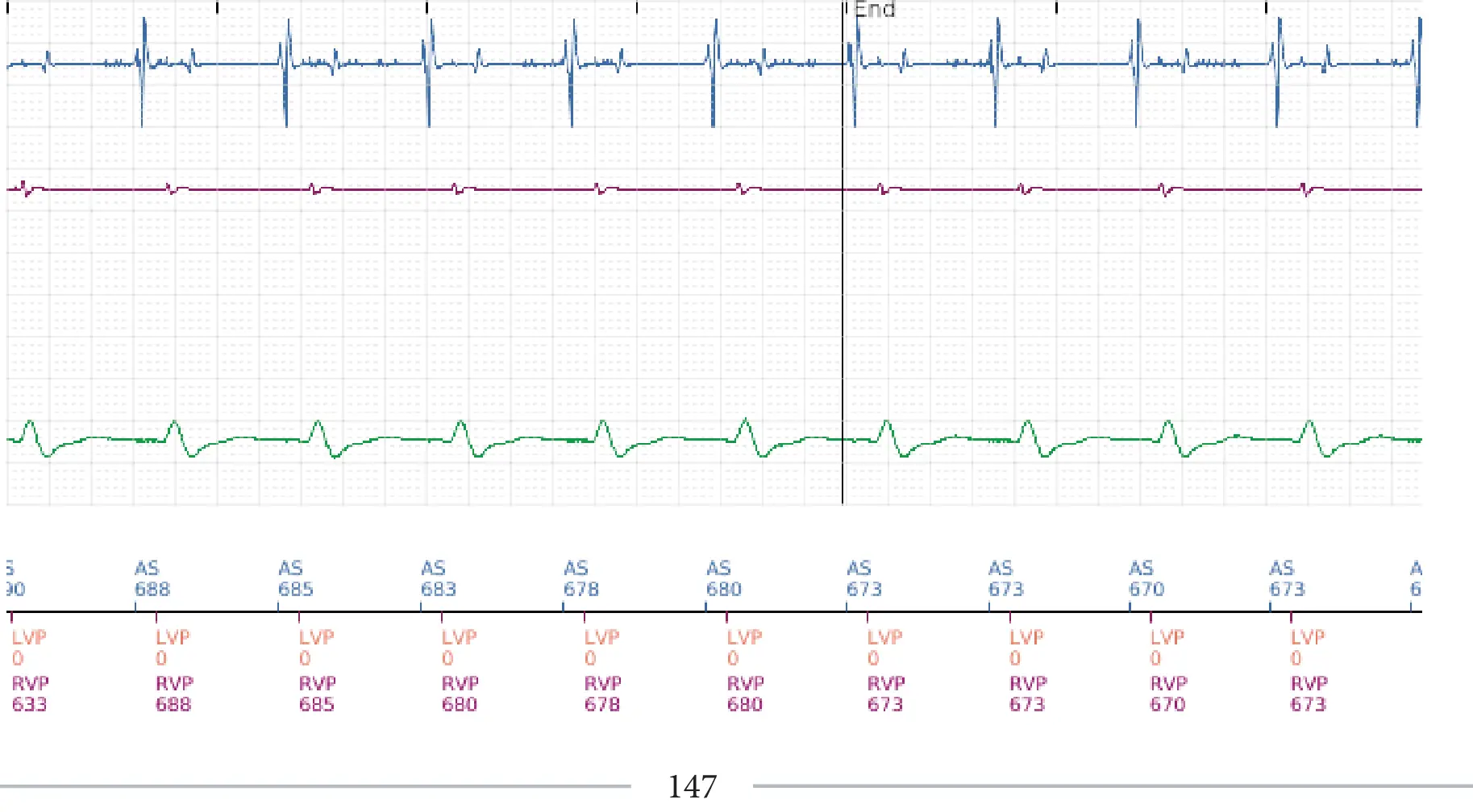 Boston Scientific ICD electrogram, segment 5 of 5 — Anti-tachycardia pacing in the VT zone